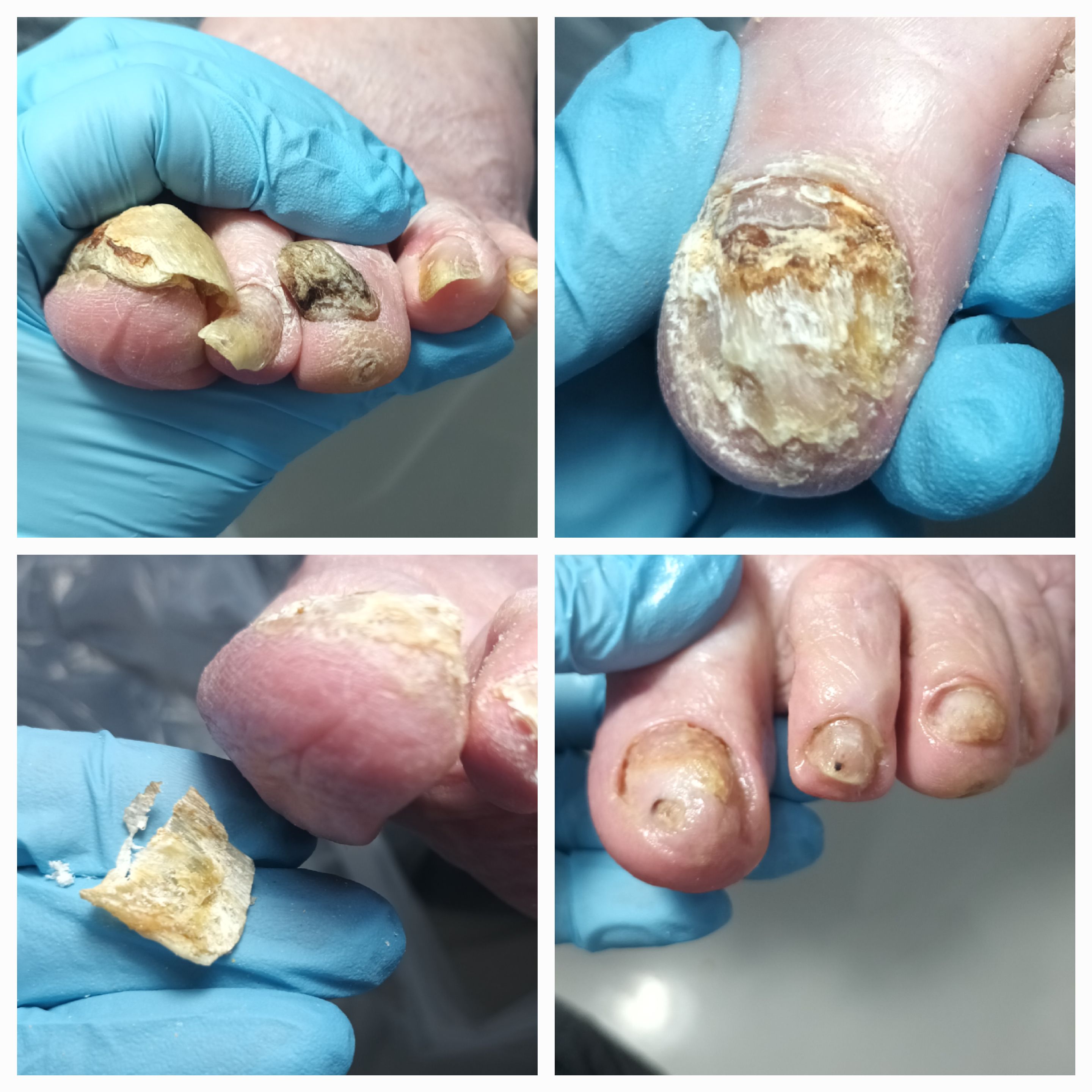 Choroby i defekty płytki paznokciowej - zdjęcie 10