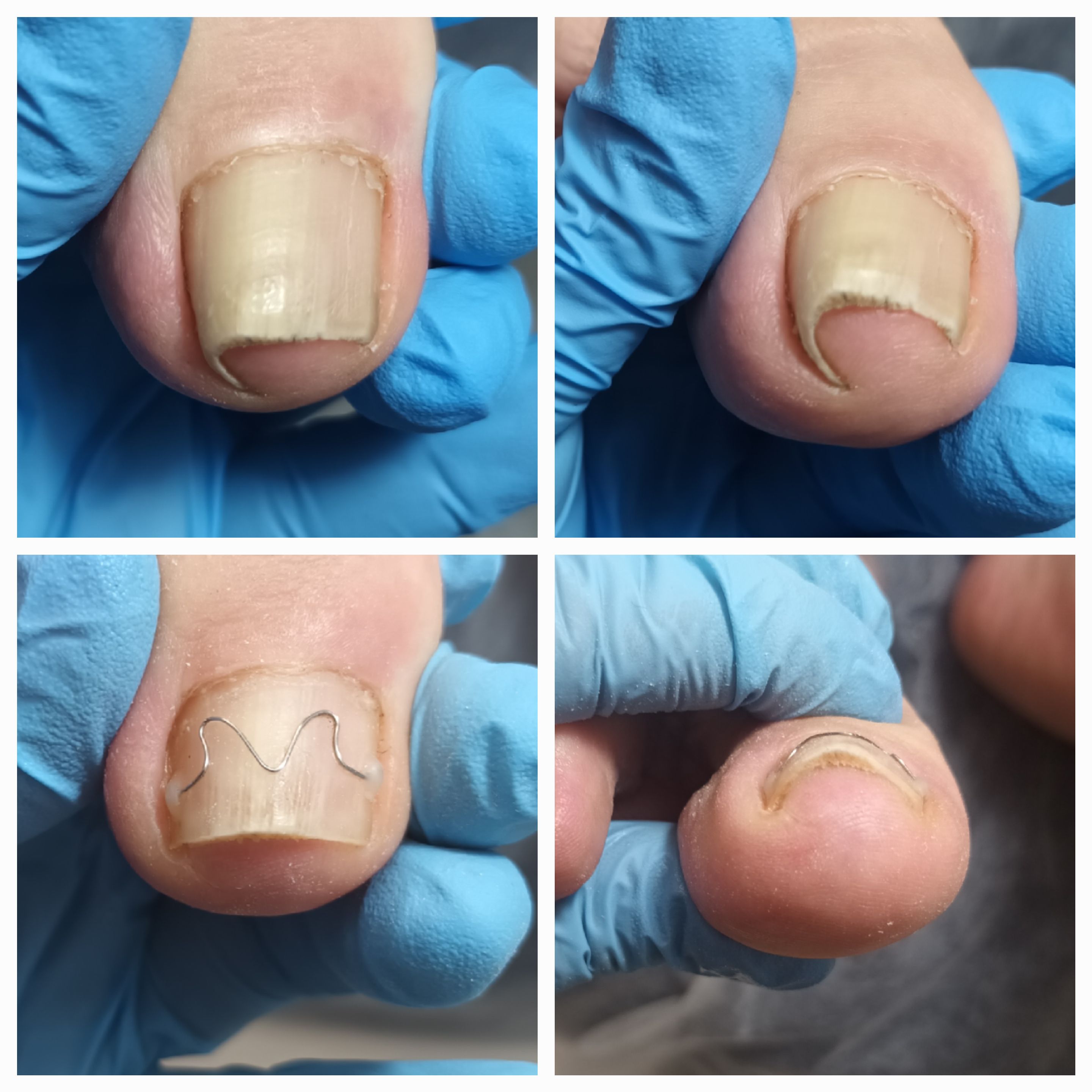 Klamry i rekonstrukcje podologiczne - zdjęcie 10