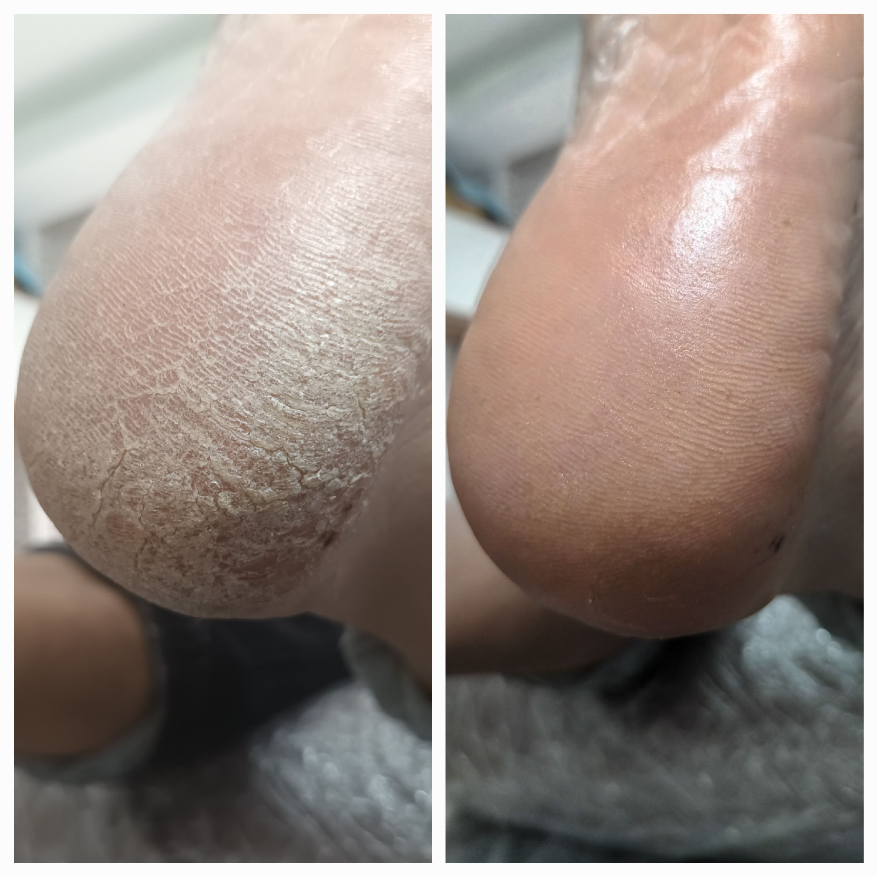 Pedicure leczniczy - zdjęcie 10