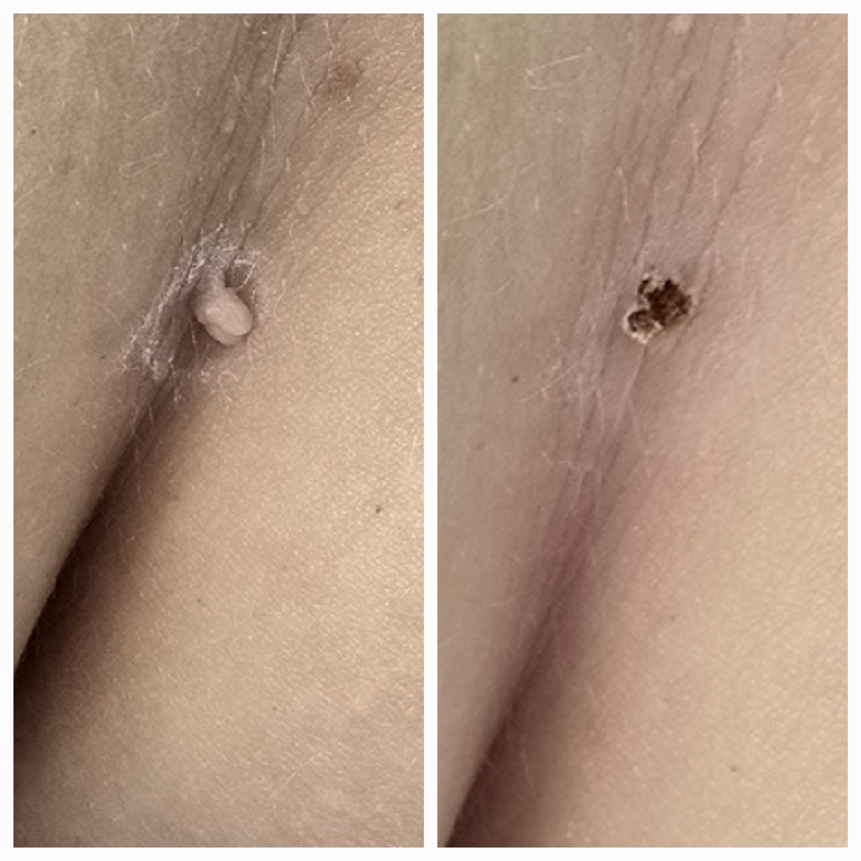 Zamykanie naczynek i usuwanie włókniaków - zdjęcie 10