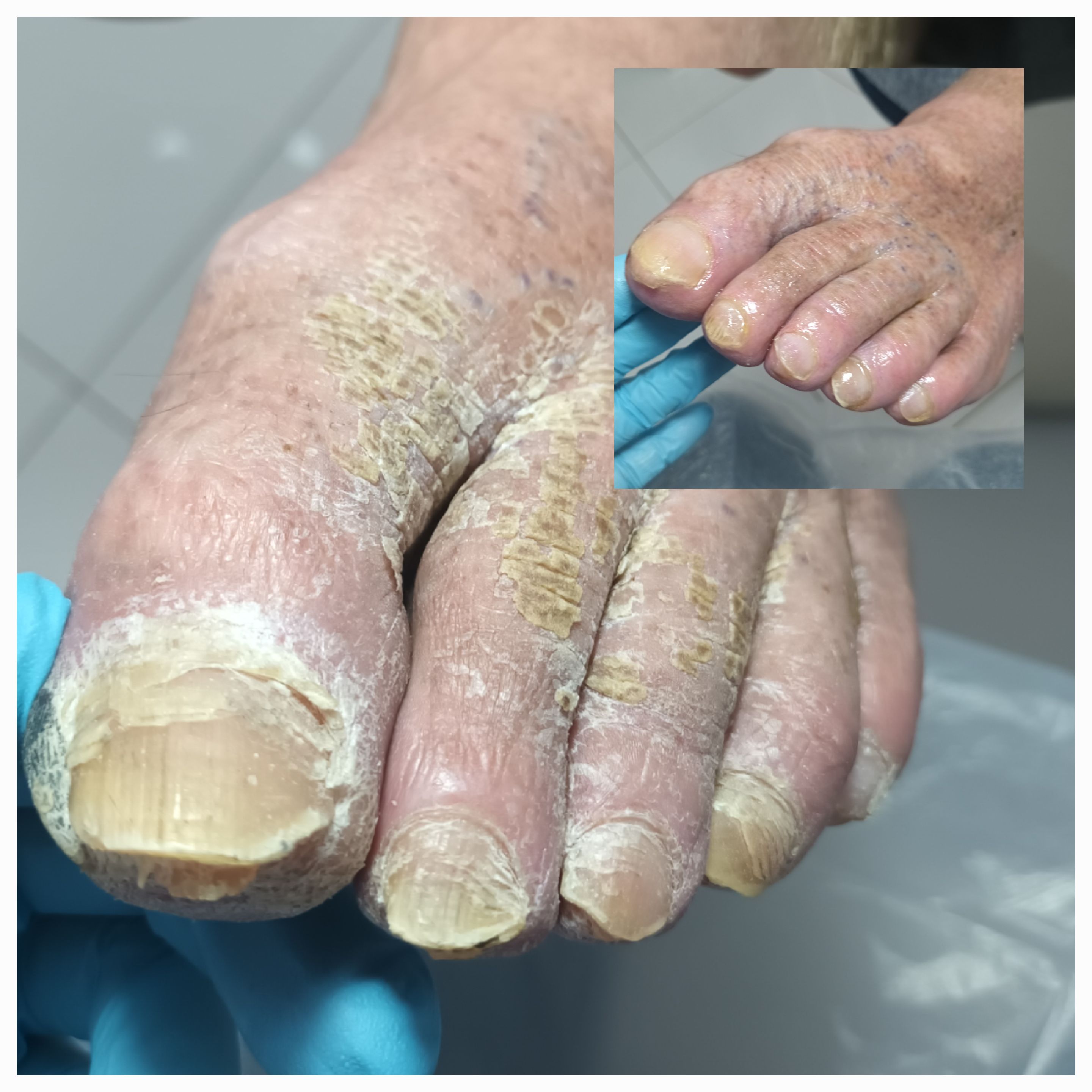 Choroby i defekty płytki paznokciowej - zdjęcie 11