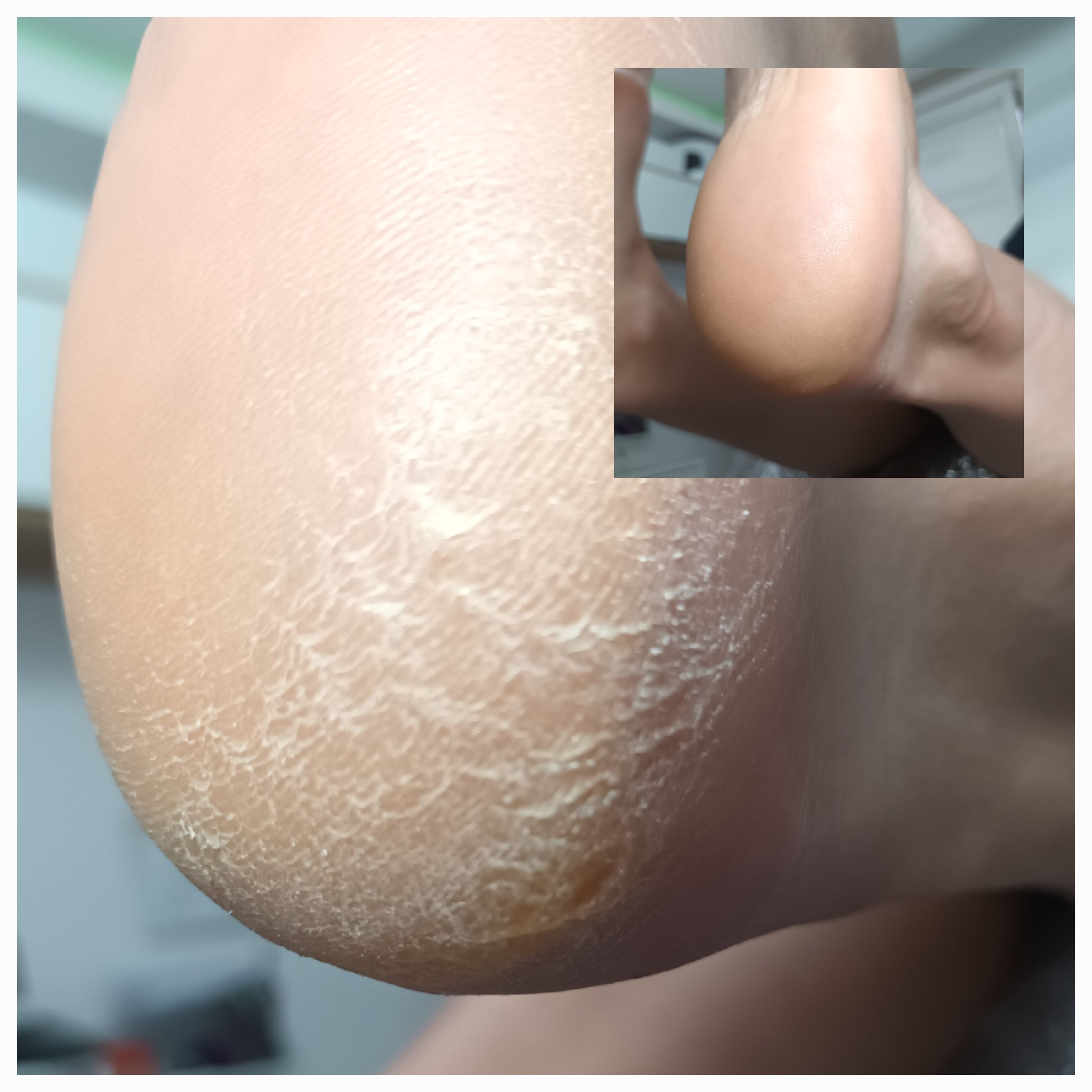 Pedicure leczniczy - zdjęcie 11