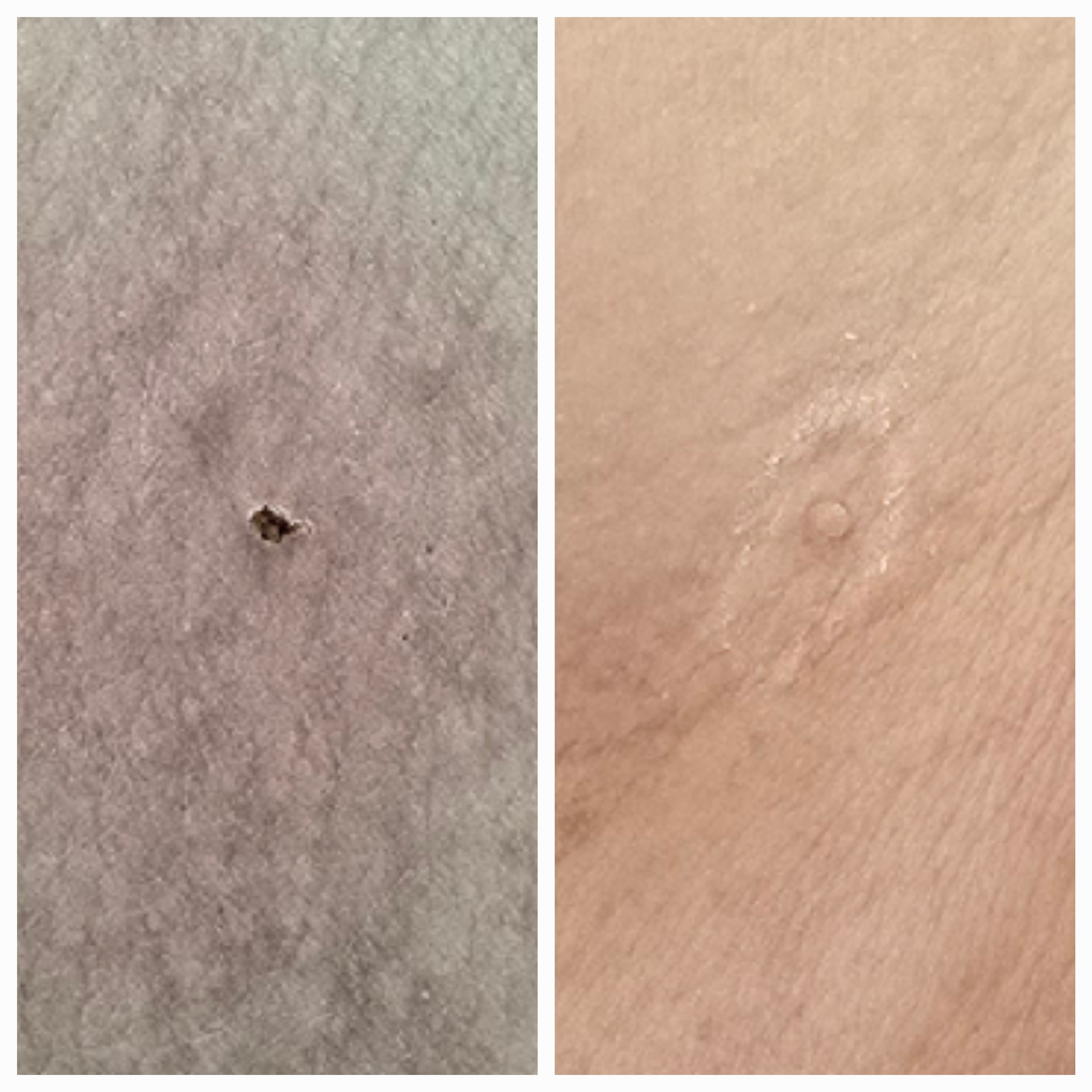 Zamykanie naczynek i usuwanie włókniaków - zdjęcie 11