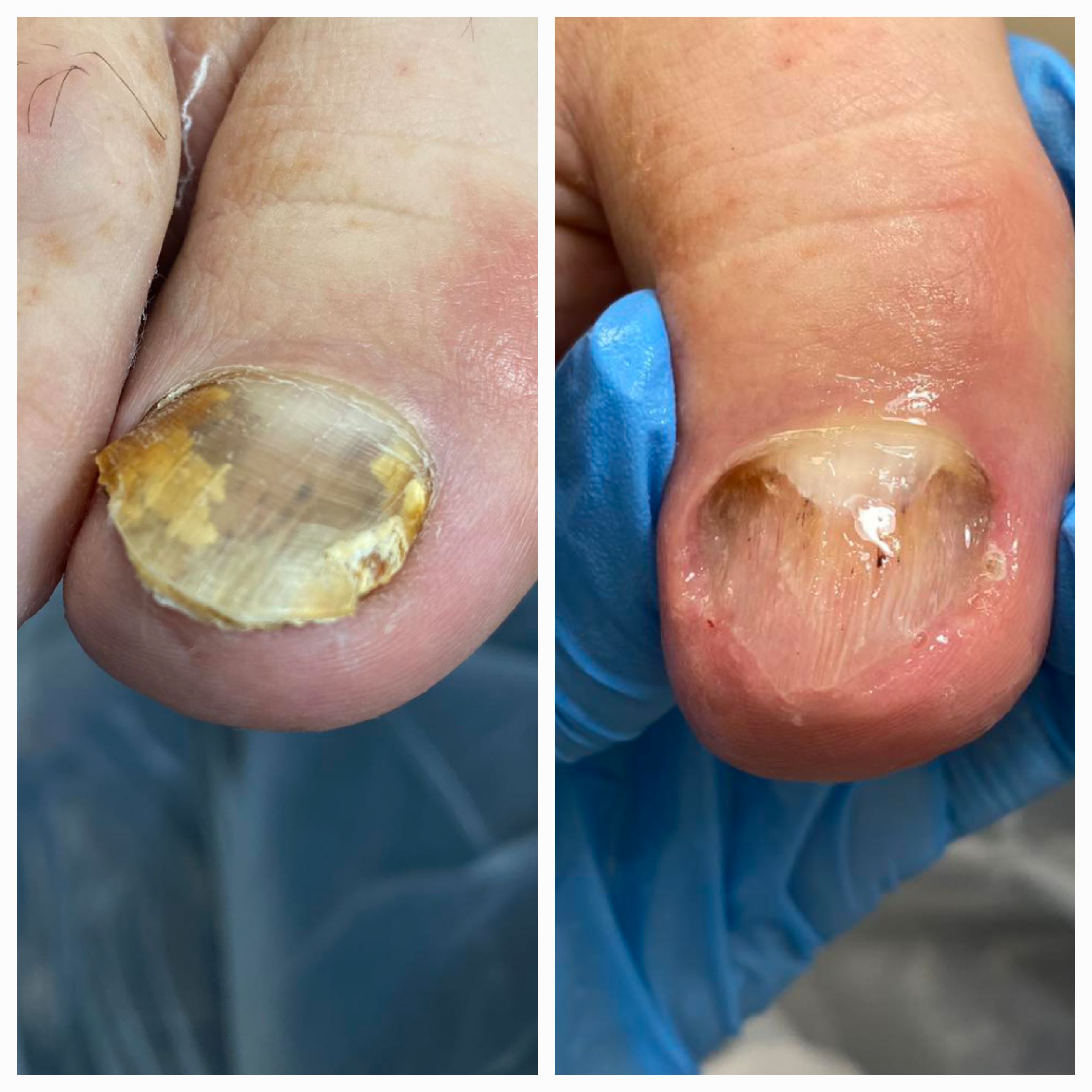 Choroby i defekty płytki paznokciowej - zdjęcie 12