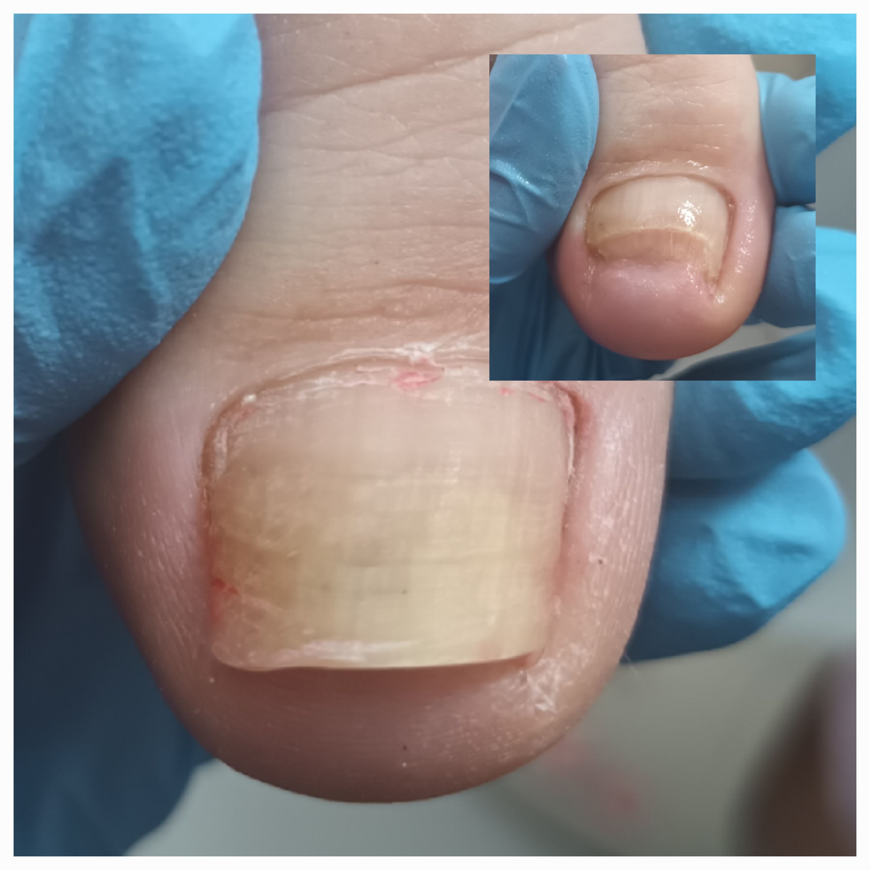 Choroby i defekty płytki paznokciowej - zdjęcie 13