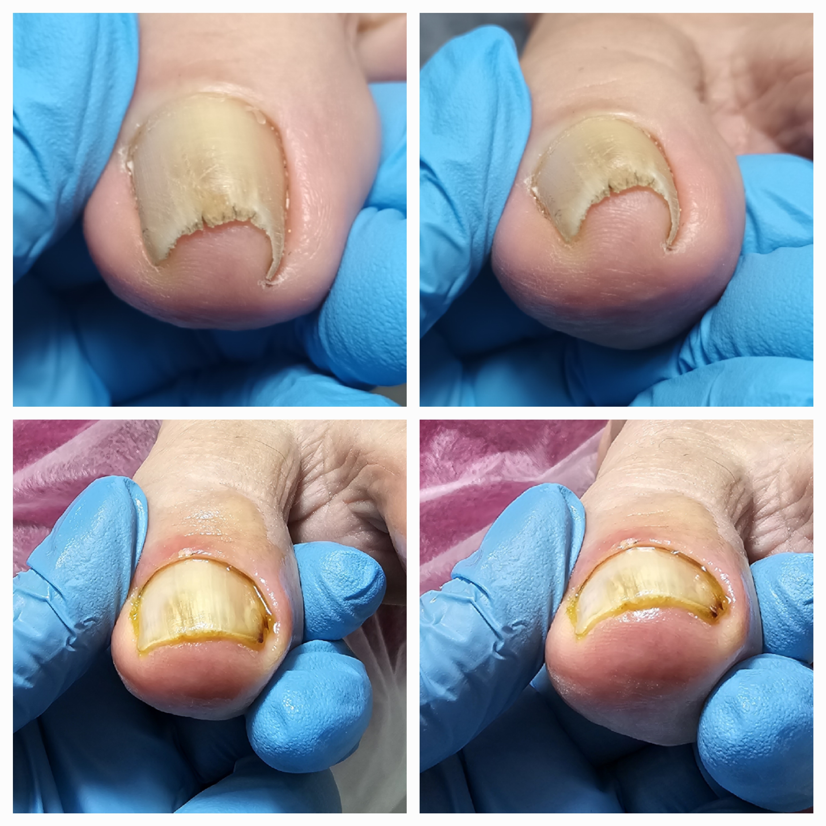 Klamry i rekonstrukcje podologiczne - zdjęcie 13