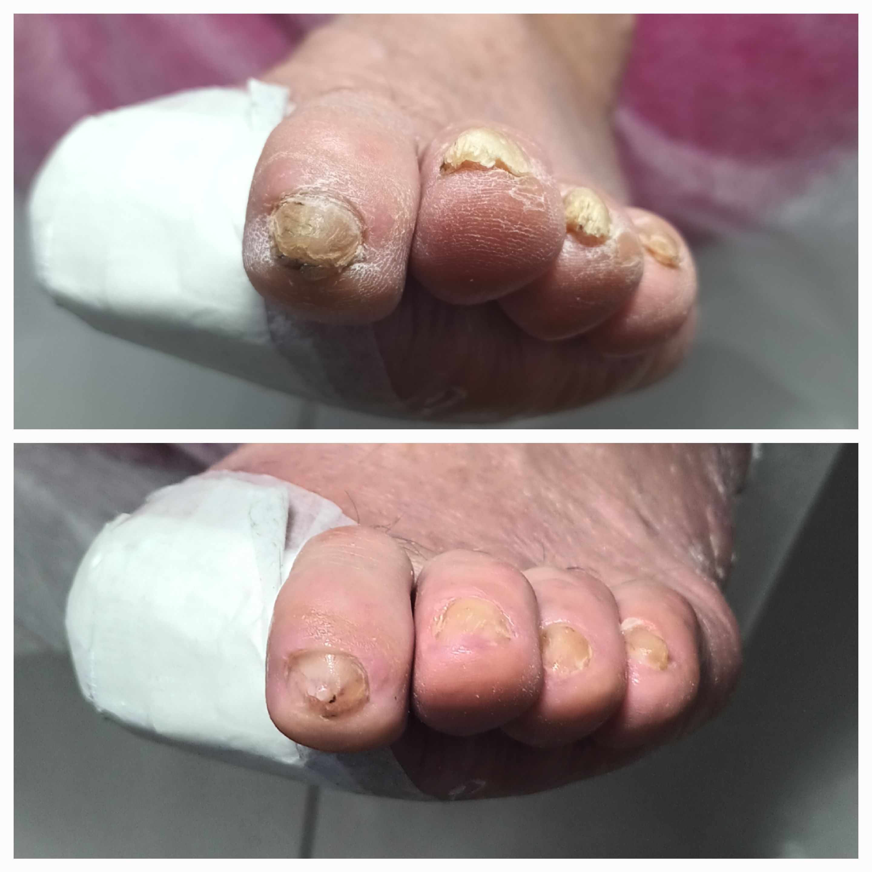 Choroby i defekty płytki paznokciowej - zdjęcie 14