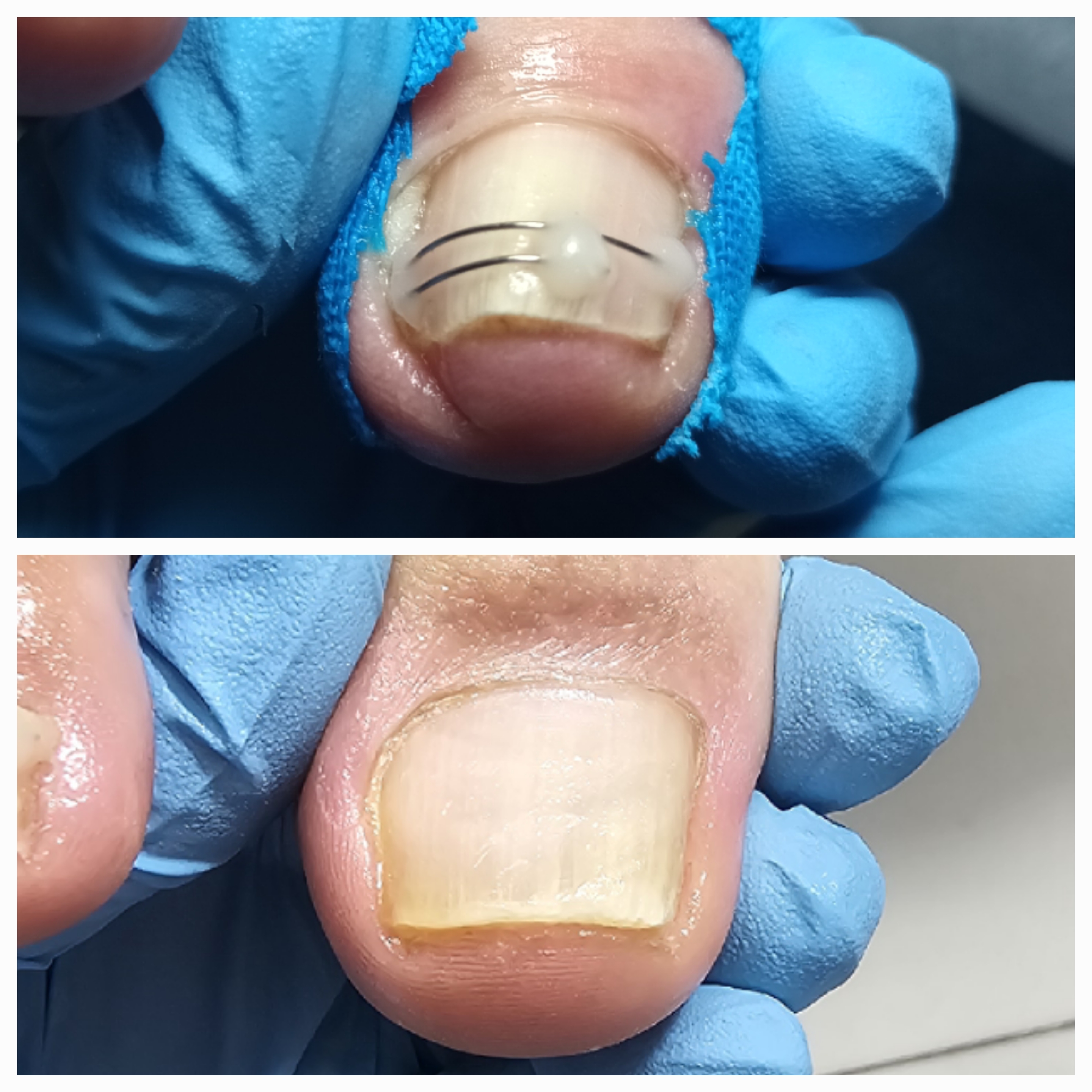 Klamry i rekonstrukcje podologiczne - zdjęcie 14