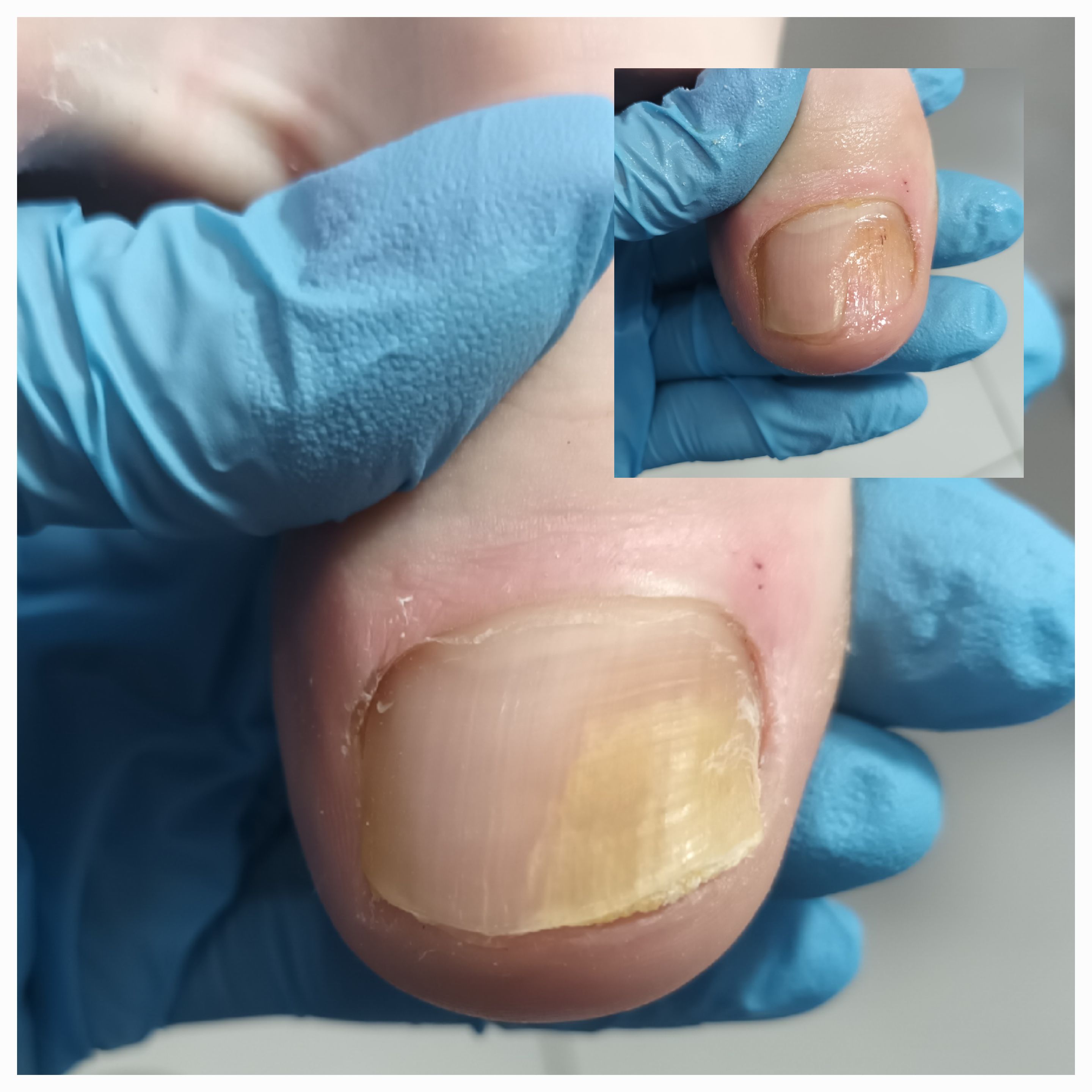 Choroby i defekty płytki paznokciowej - zdjęcie 15