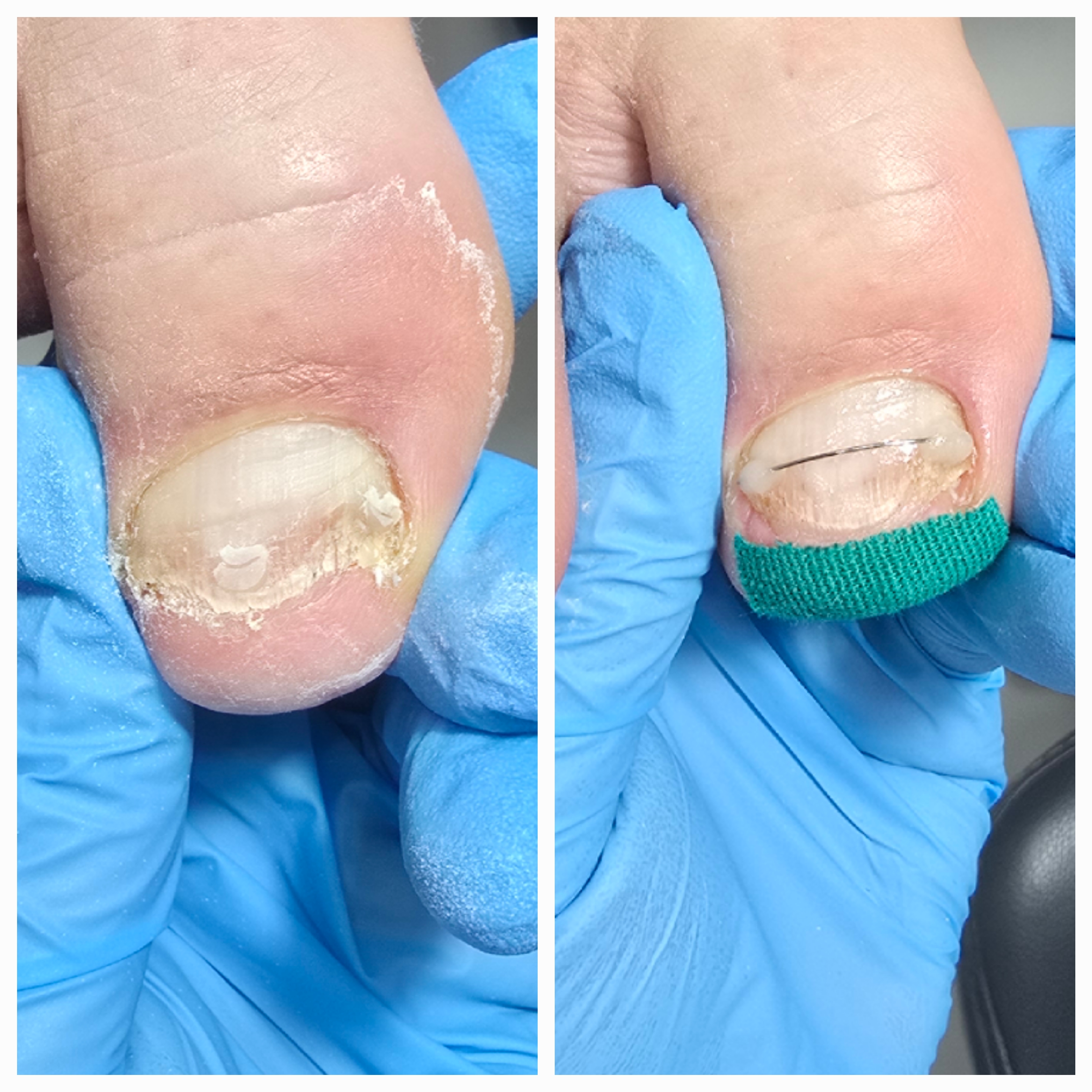 Klamry i rekonstrukcje podologiczne - zdjęcie 15