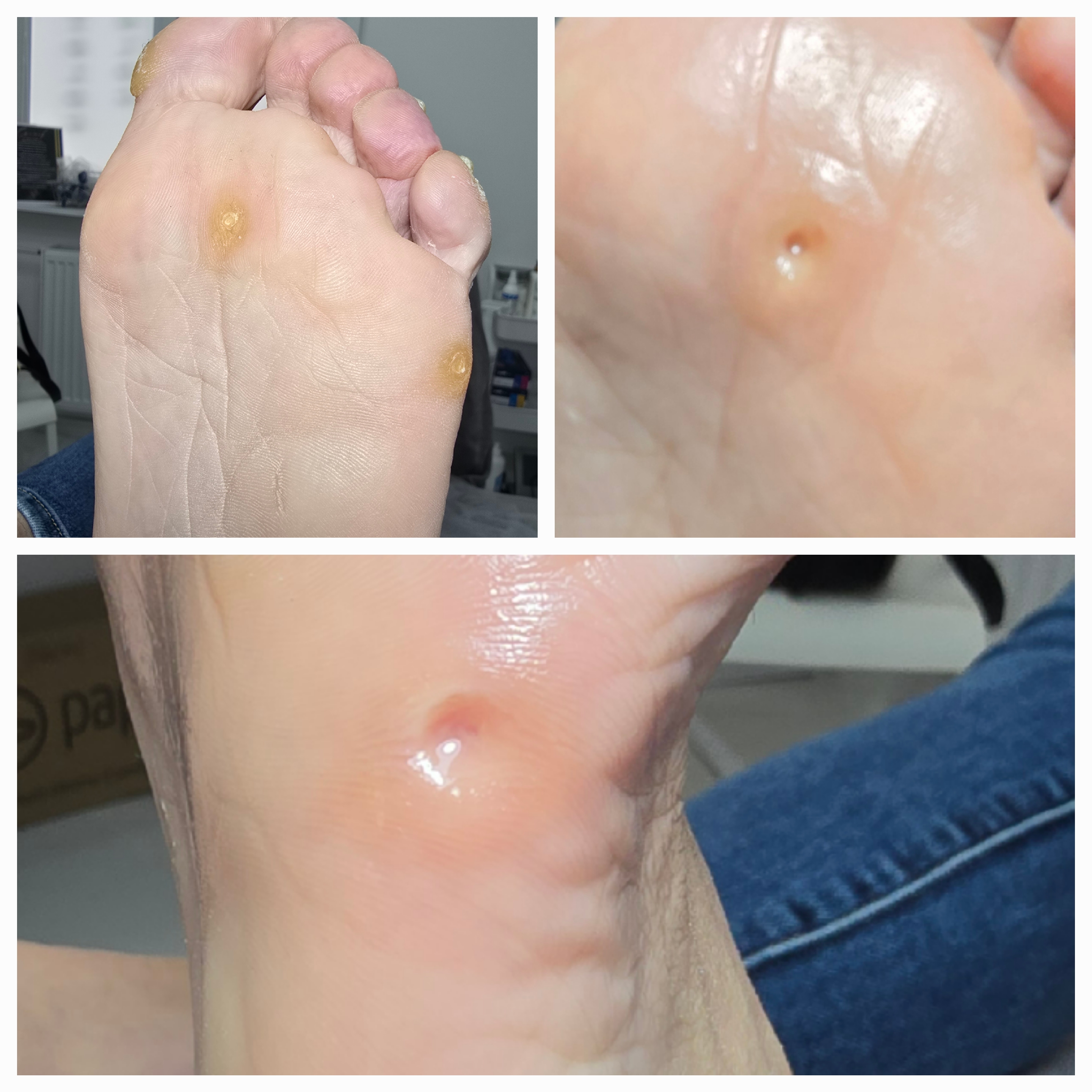 Usuwanie modzeli i odcisków - zdjęcie 15