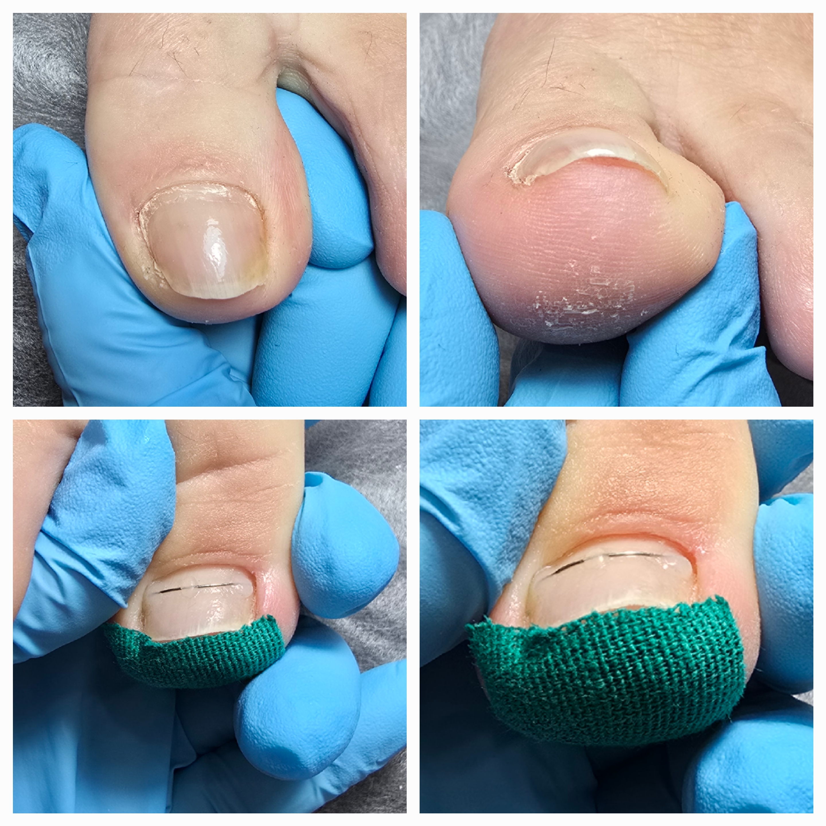 Klamry i rekonstrukcje podologiczne - zdjęcie 16