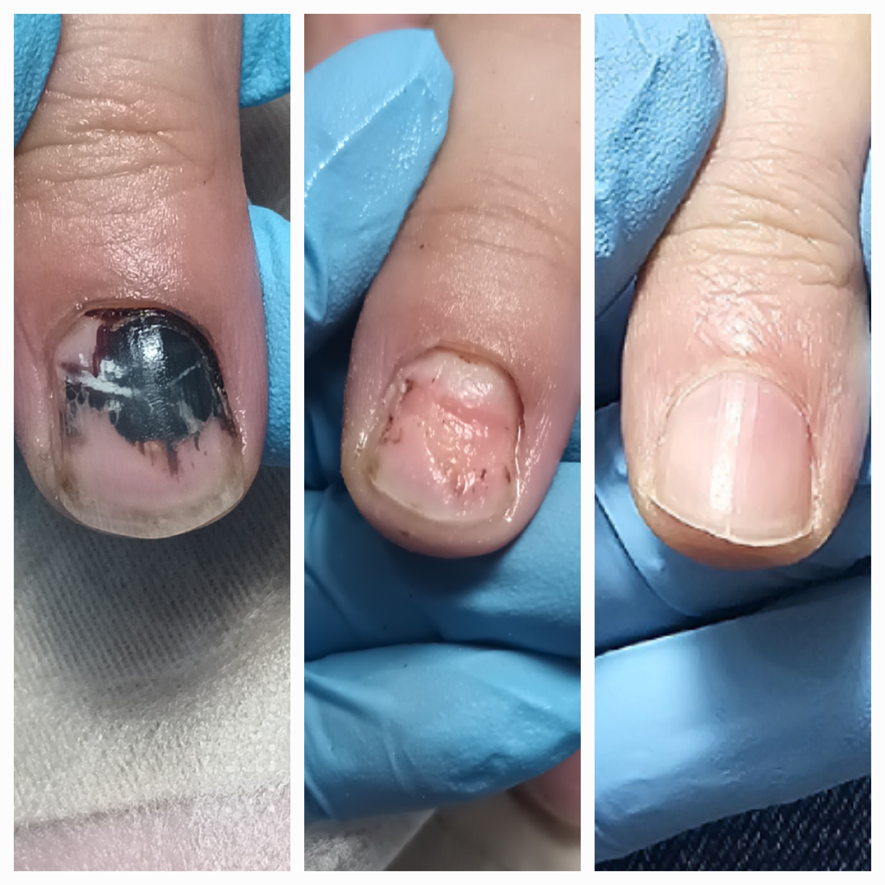 Choroby i defekty płytki paznokciowej - zdjęcie 17