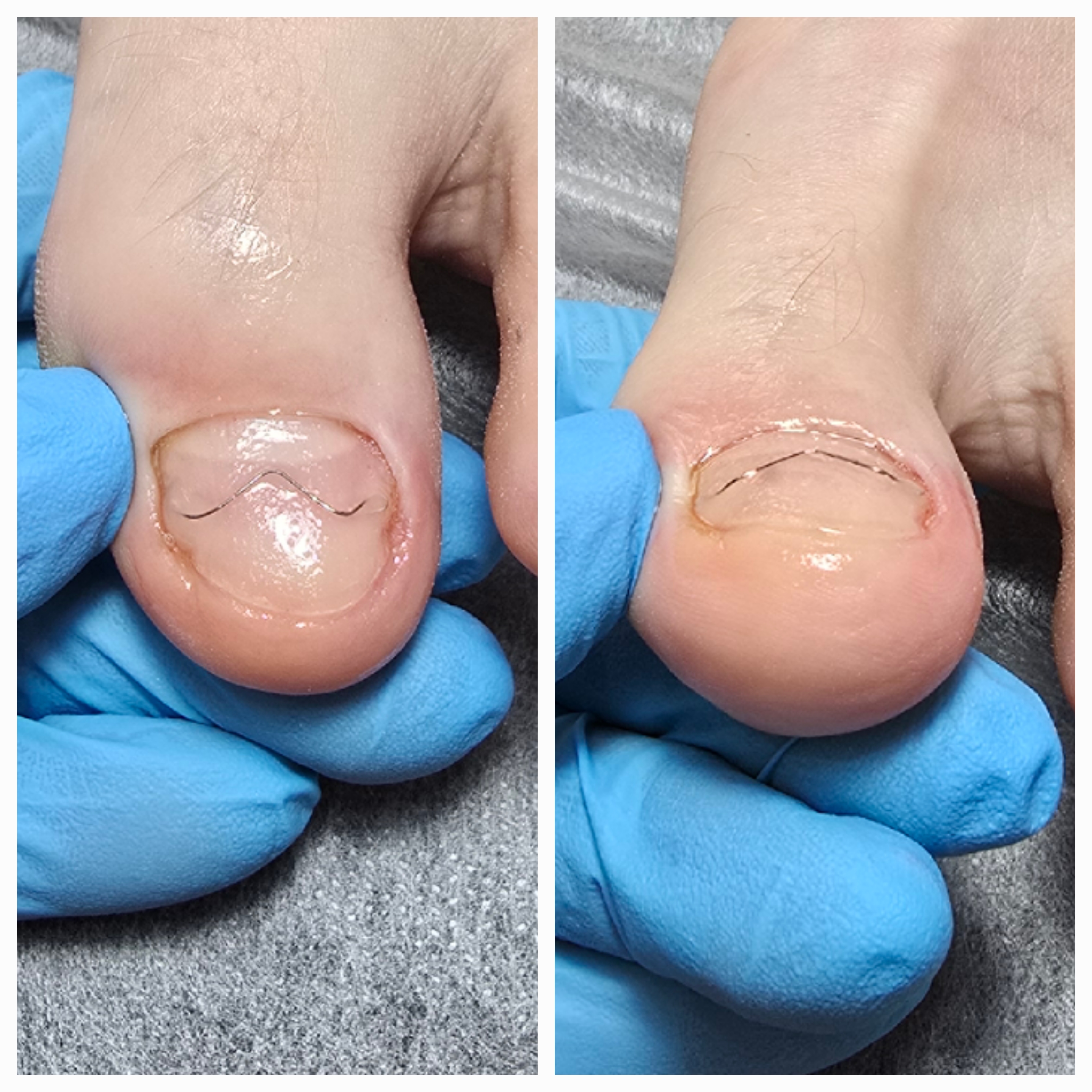 Klamry i rekonstrukcje podologiczne - zdjęcie 17