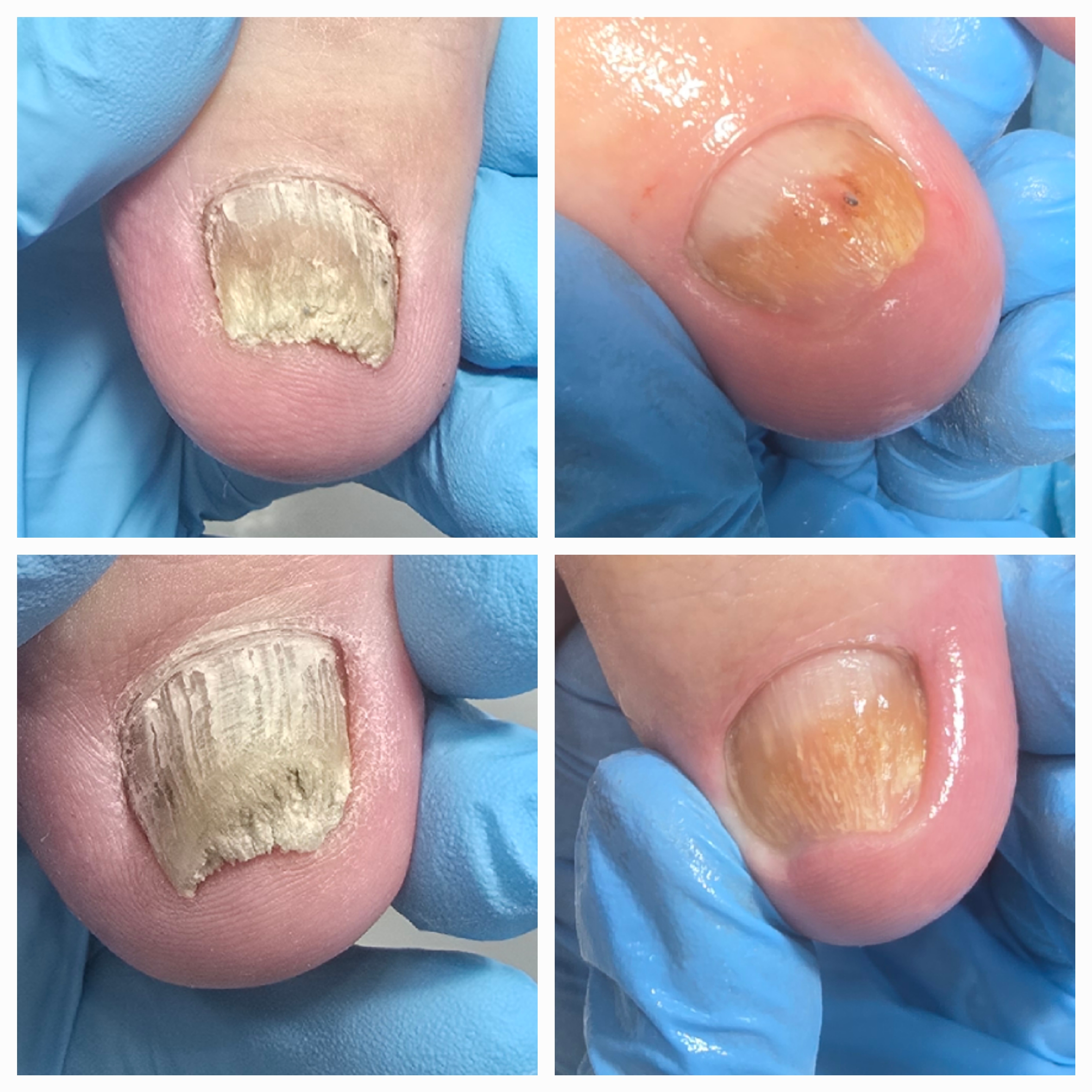 Choroby i defekty płytki paznokciowej - zdjęcie 18