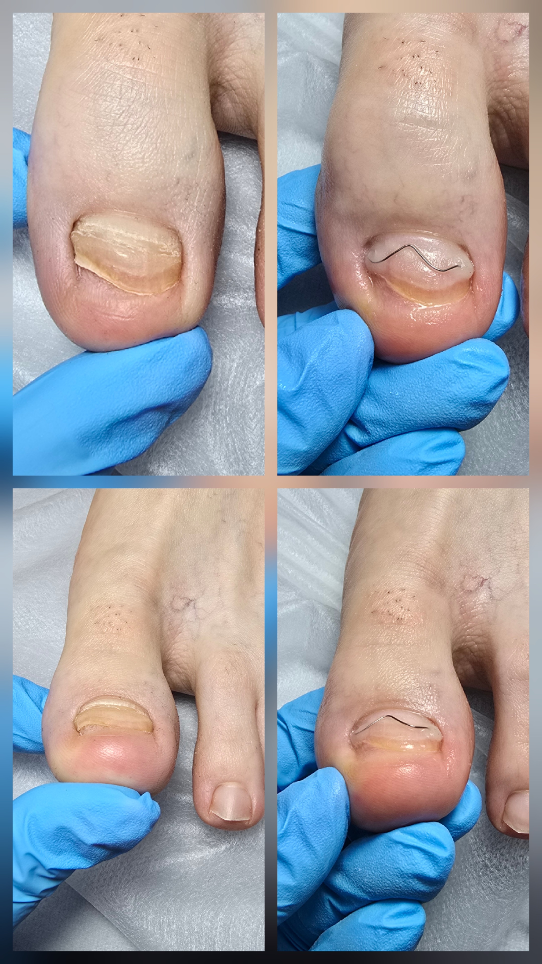 Klamry i rekonstrukcje podologiczne - zdjęcie 18