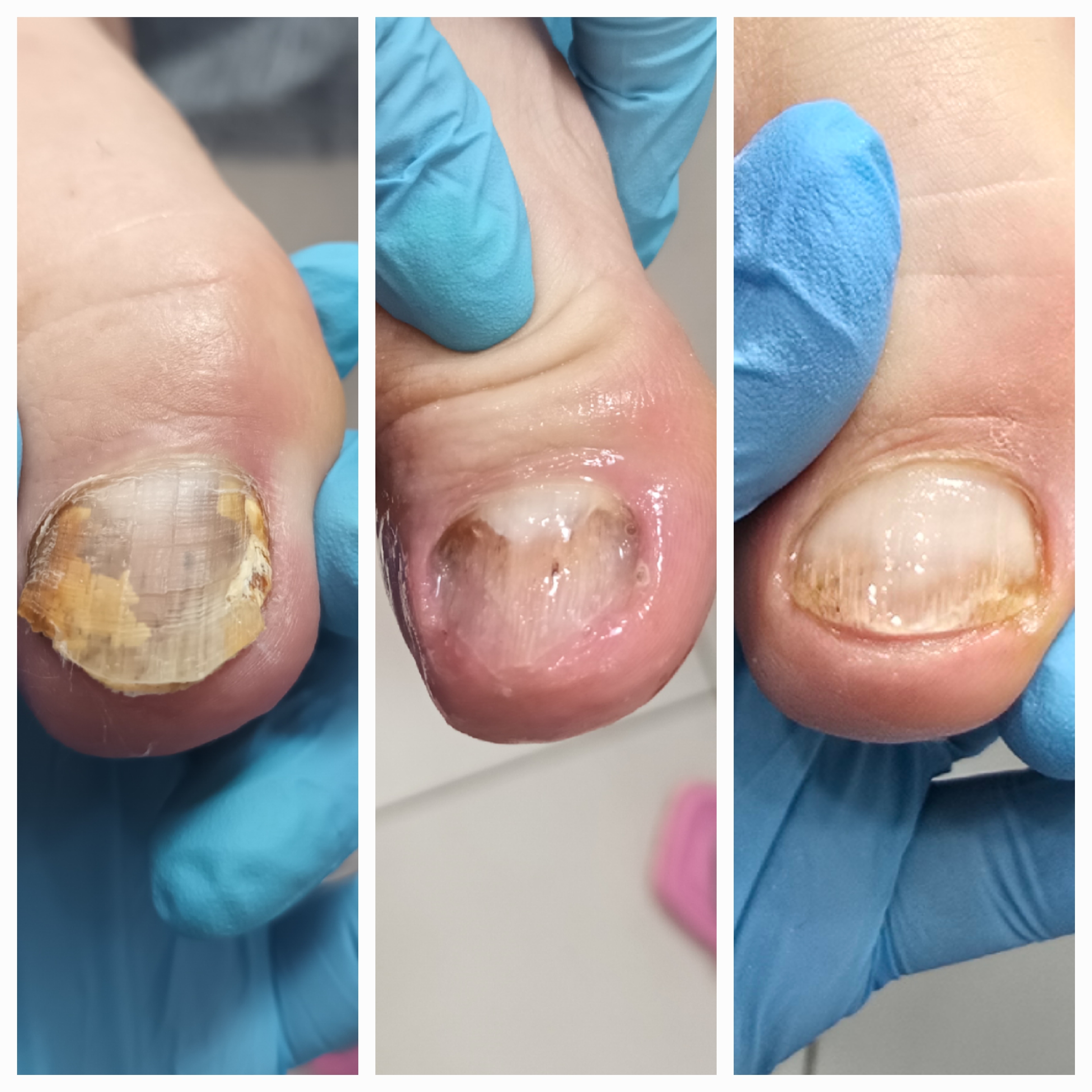 Choroby i defekty płytki paznokciowej - zdjęcie 19