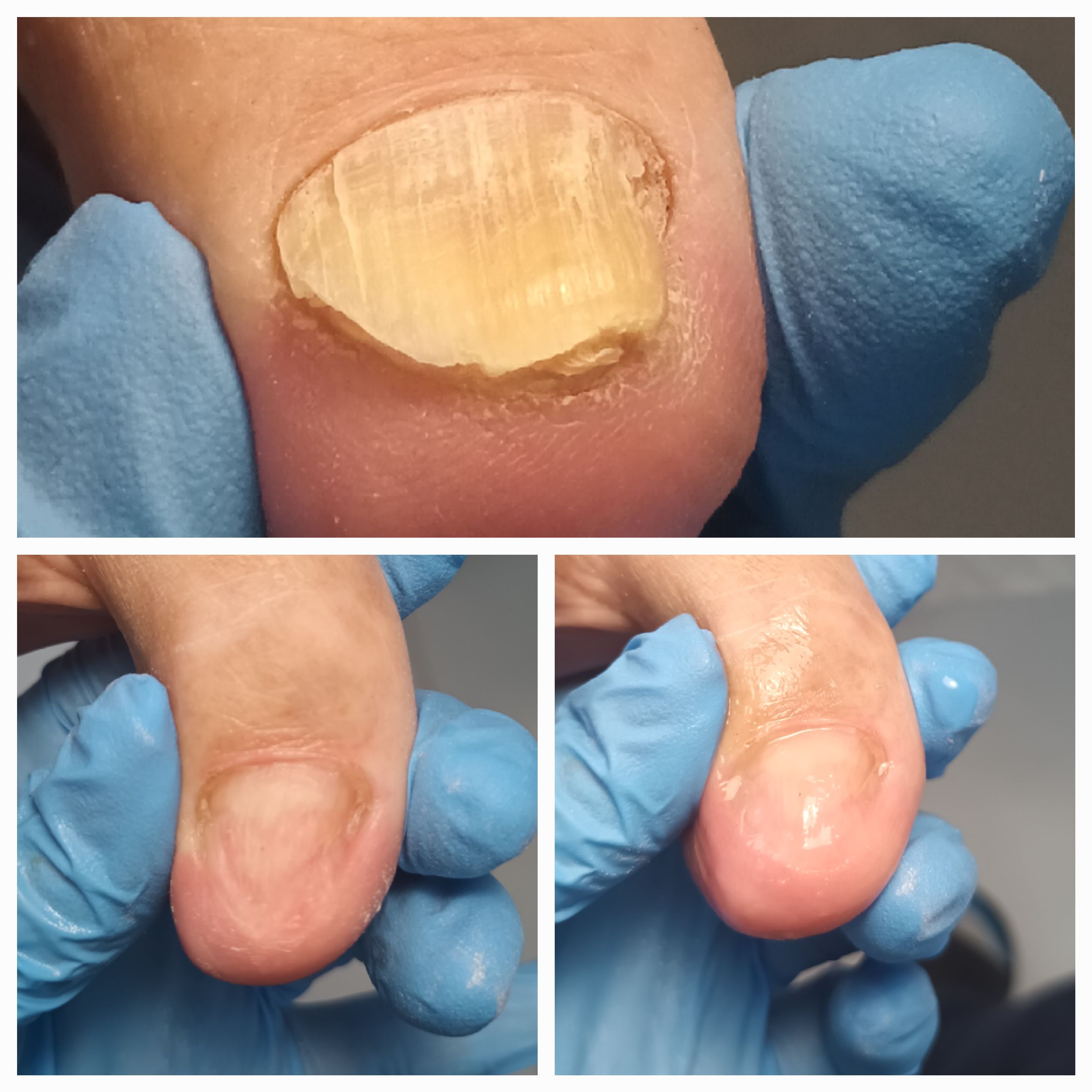 Choroby i defekty płytki paznokciowej - zdjęcie 1