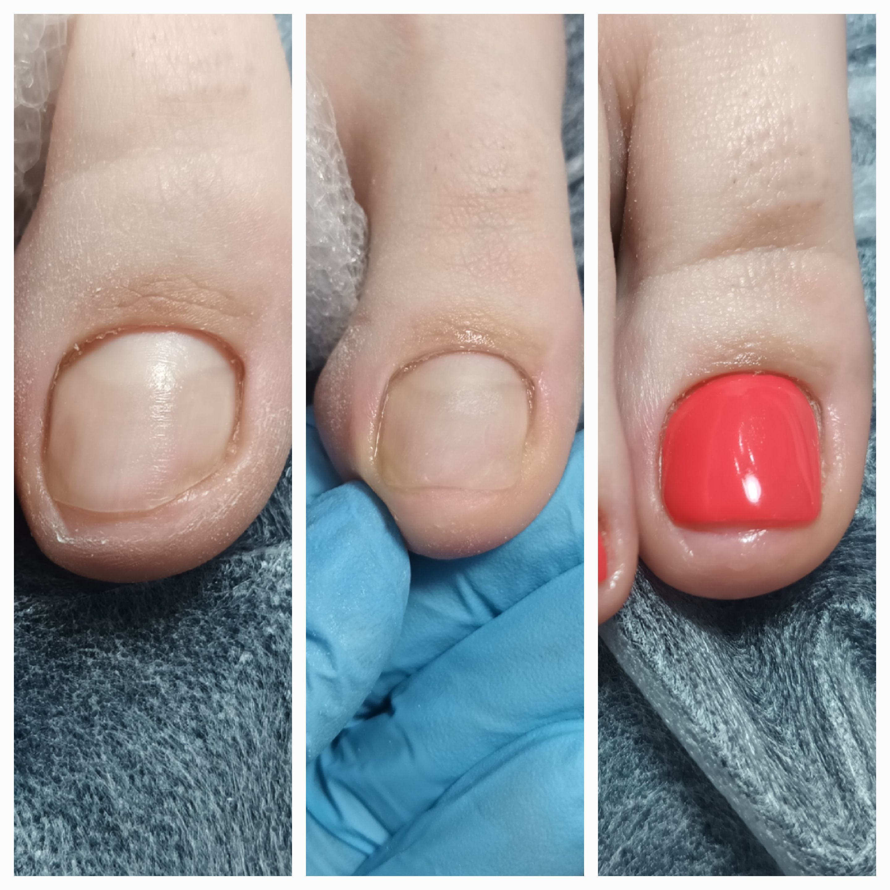 Klamry i rekonstrukcje podologiczne - zdjęcie 1