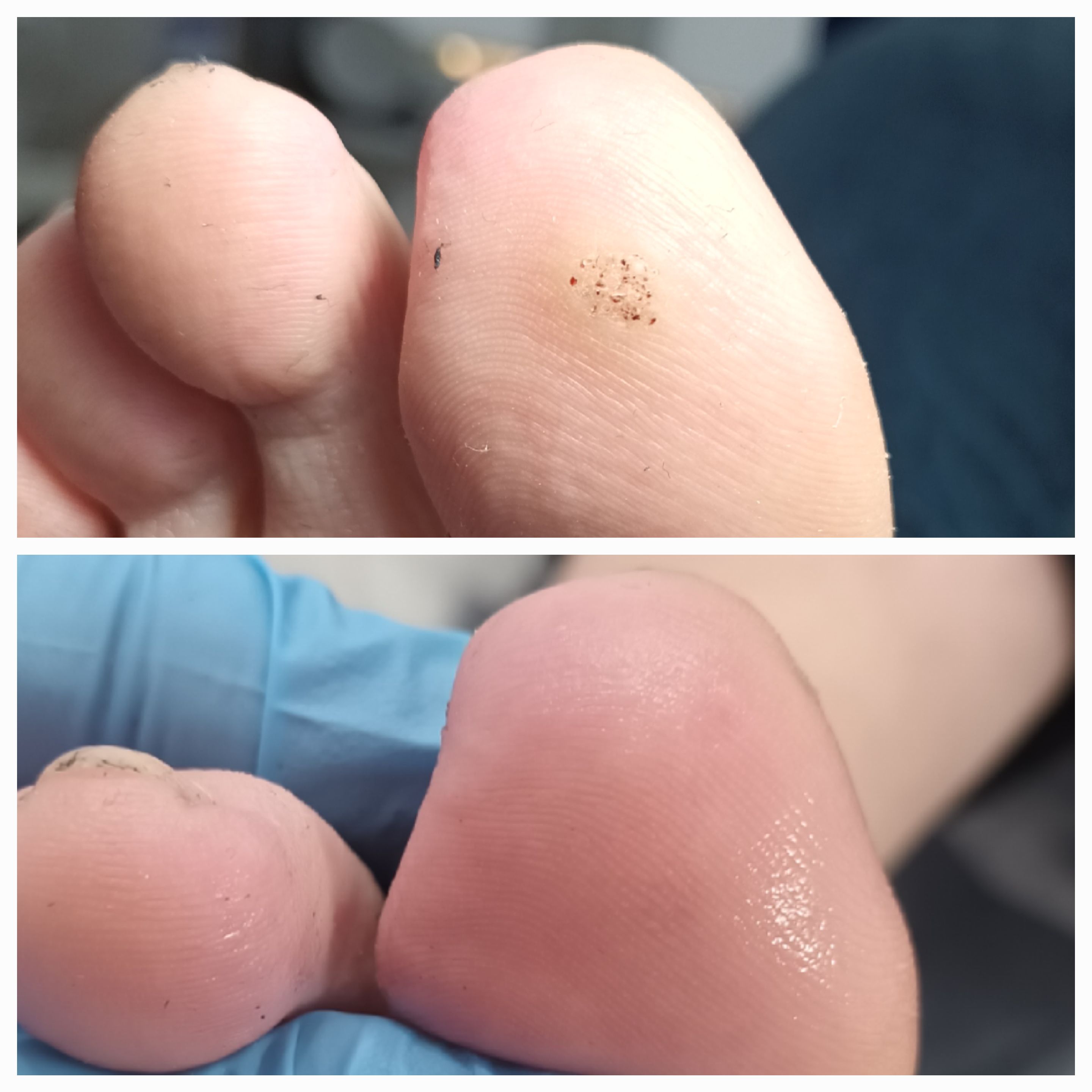 Usuwanie brodawek - zdjęcie 1