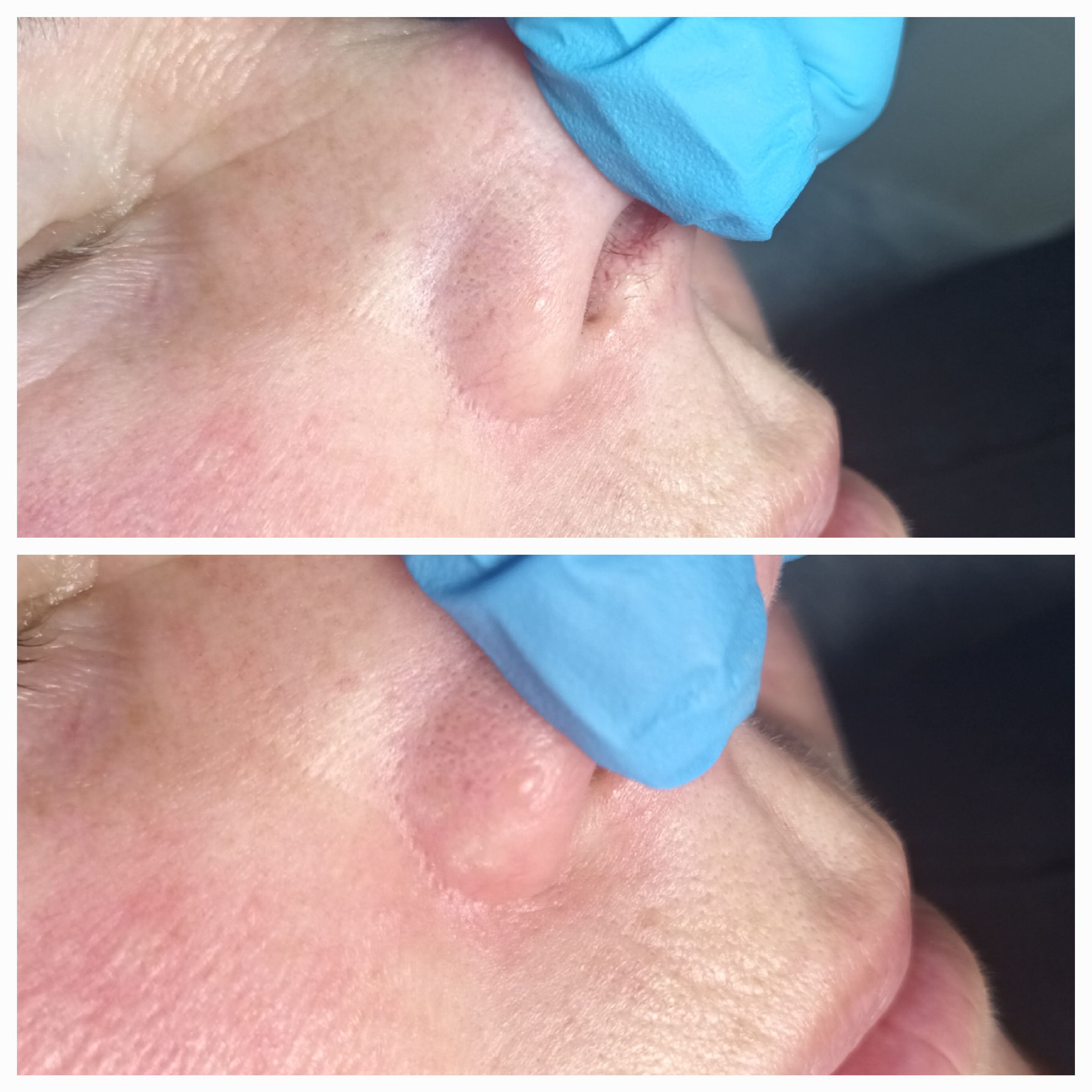 Zamykanie naczynek i usuwanie włókniaków - zdjęcie 1