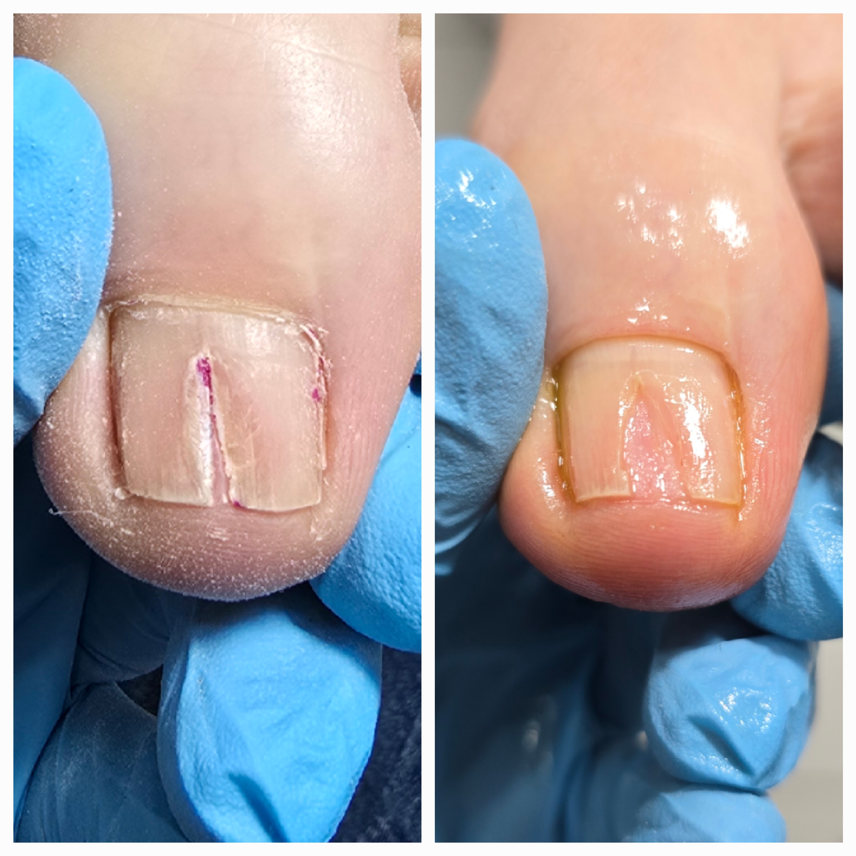 Choroby i defekty płytki paznokciowej - zdjęcie 20