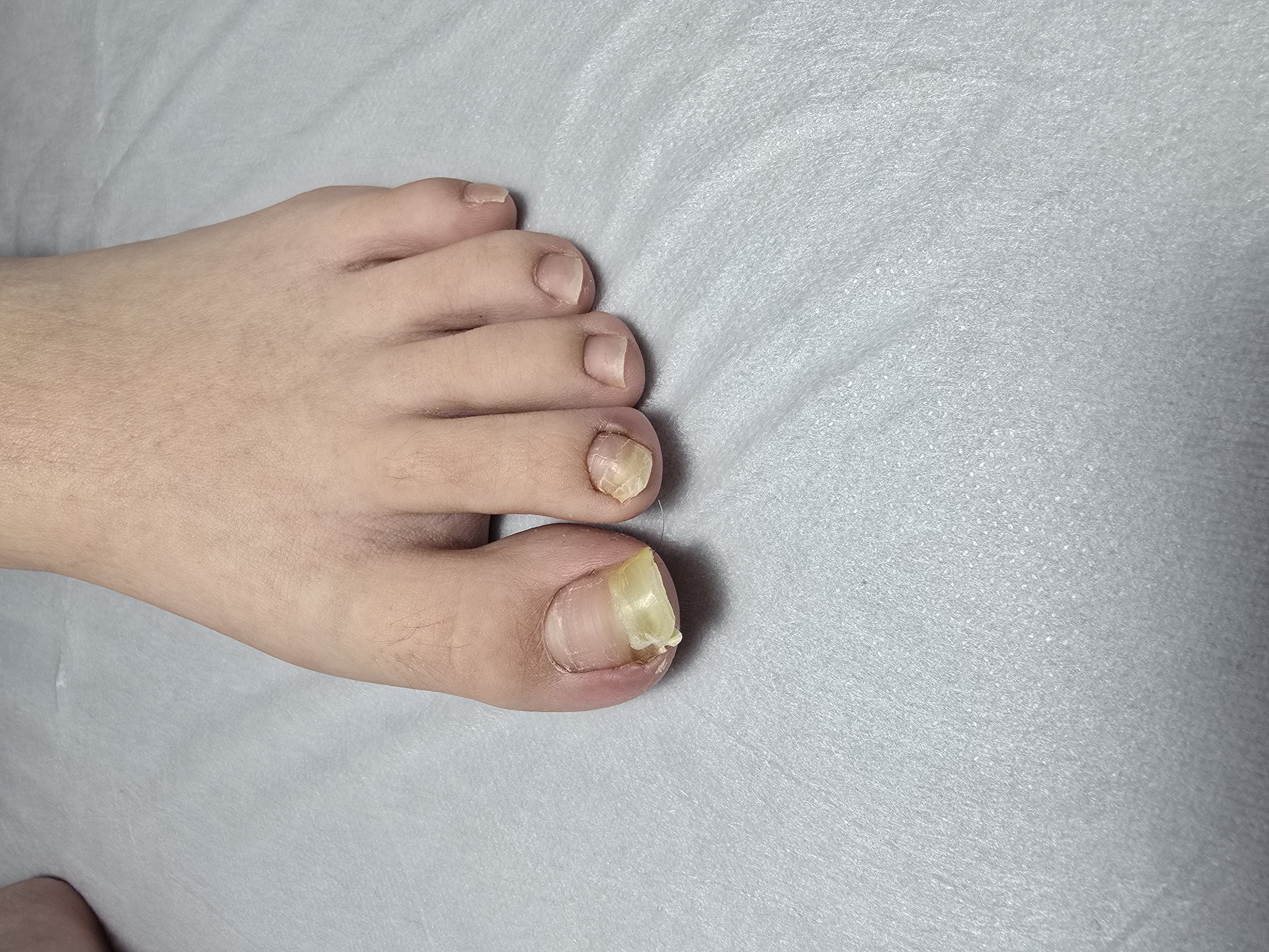 Choroby i defekty płytki paznokciowej - zdjęcie 21