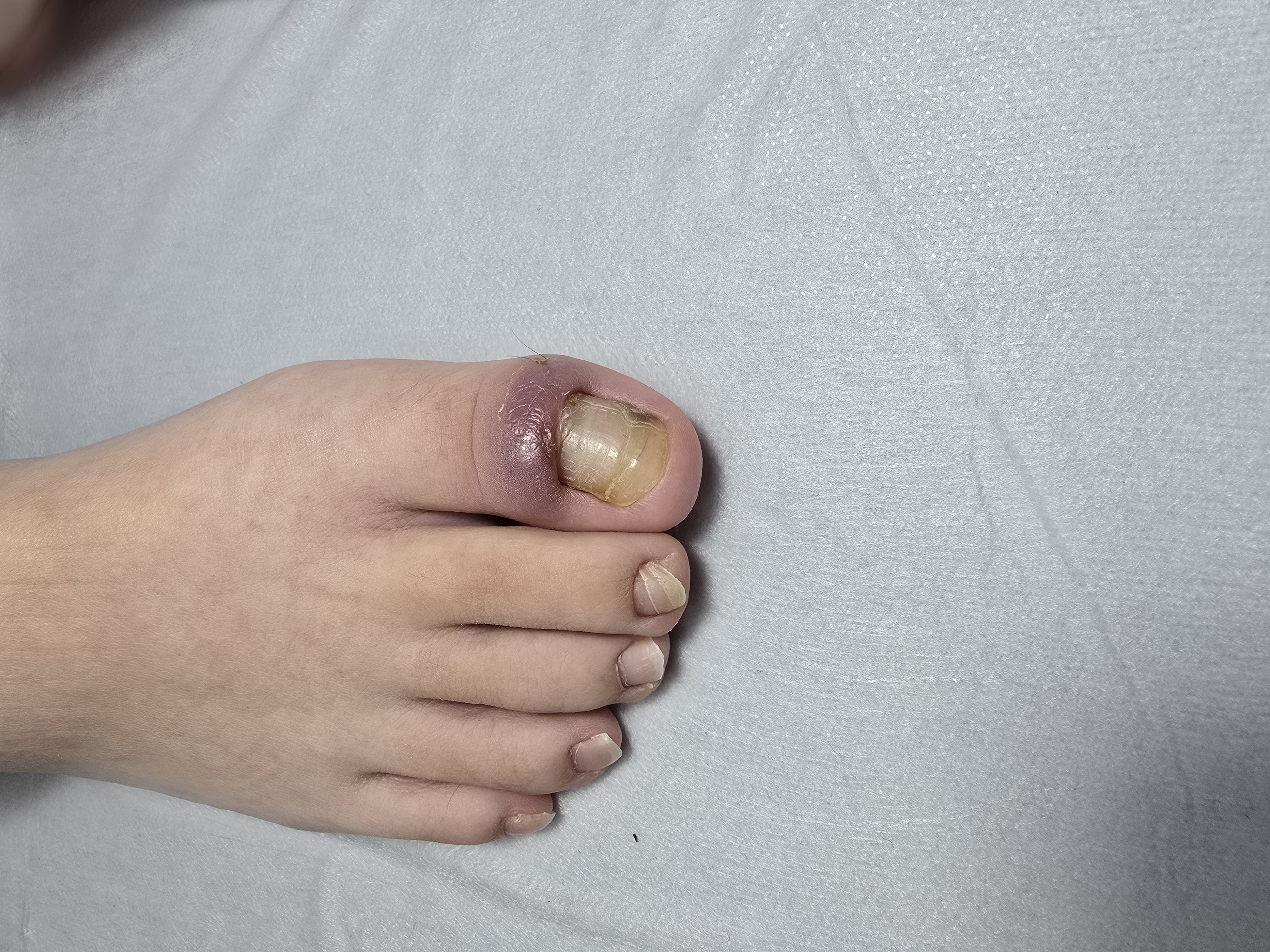 Choroby i defekty płytki paznokciowej - zdjęcie 22