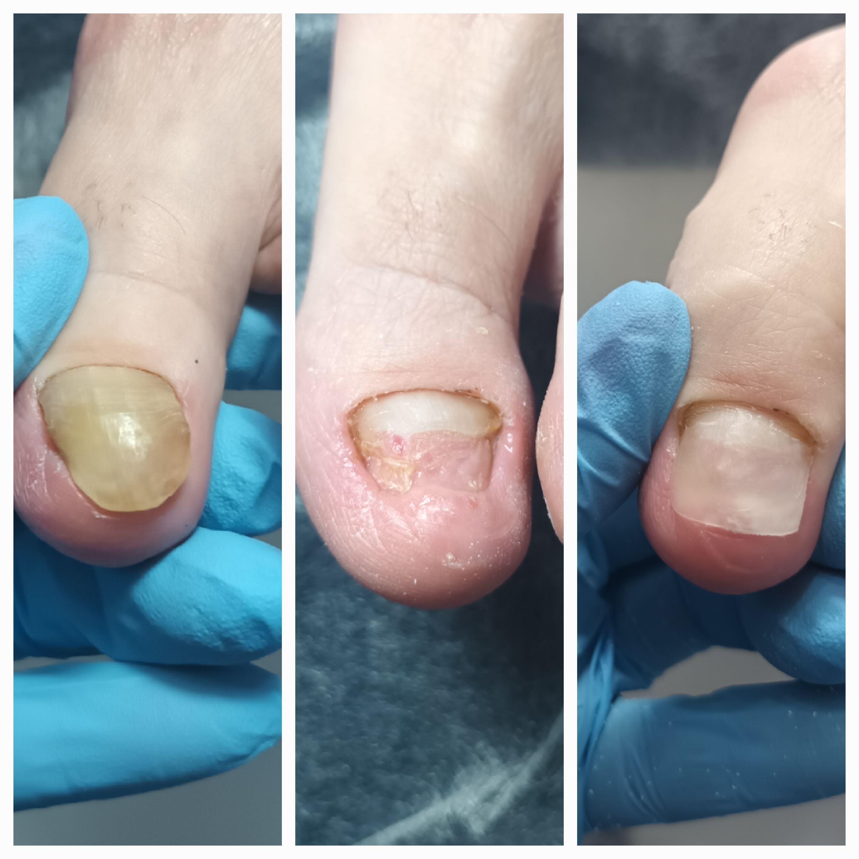 Klamry i rekonstrukcje podologiczne - zdjęcie 2