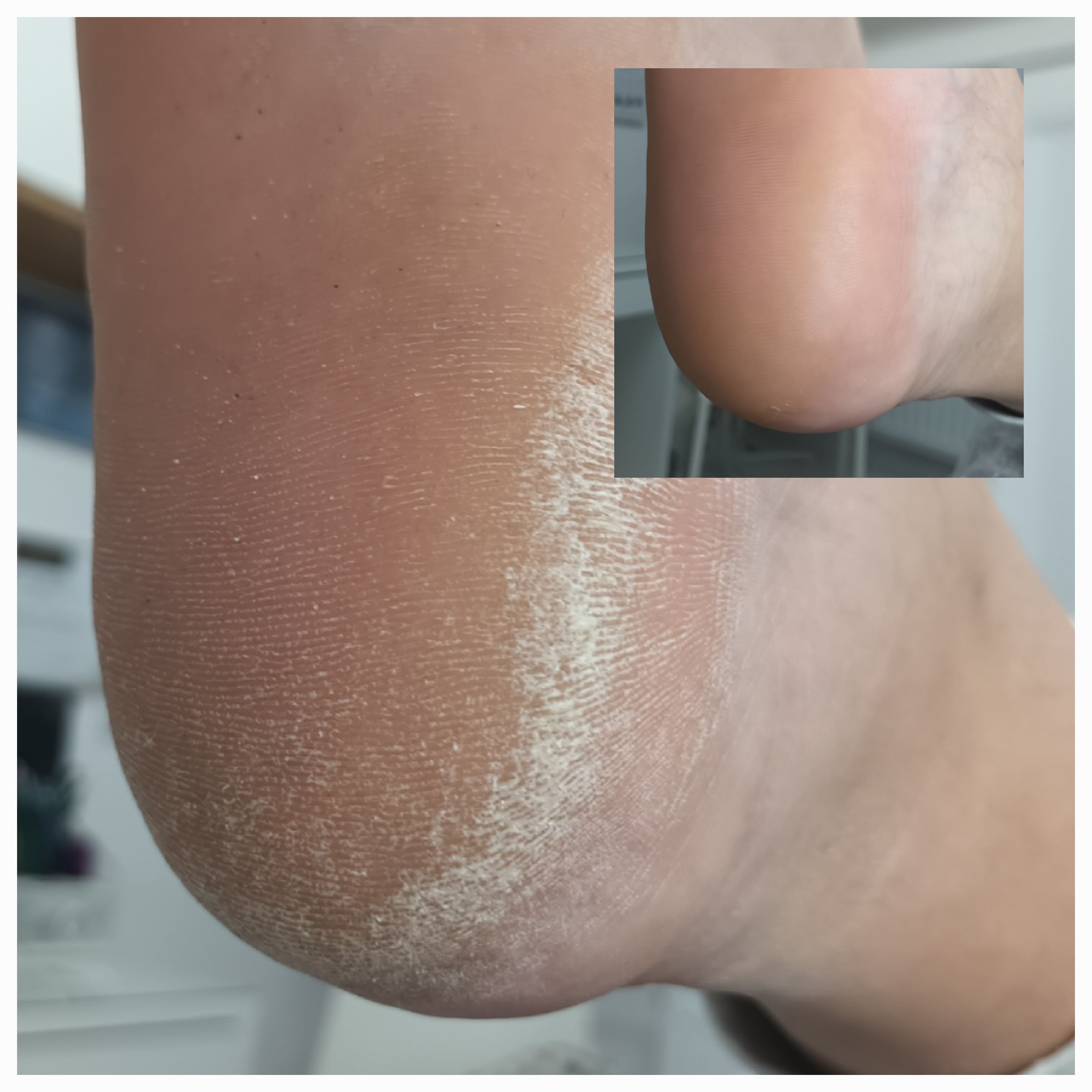 Pedicure leczniczy - zdjęcie 2