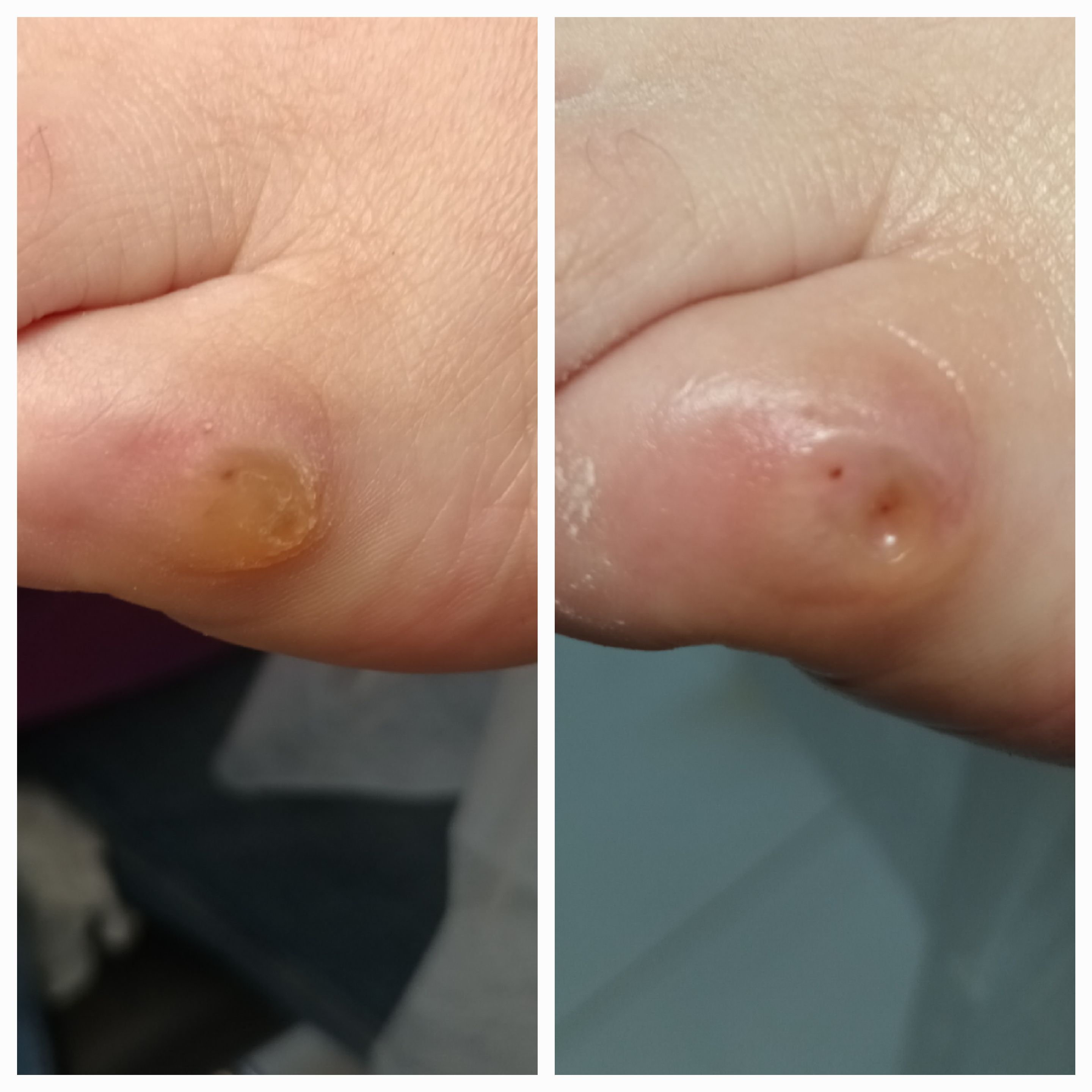 Usuwanie modzeli i odcisków - zdjęcie 2