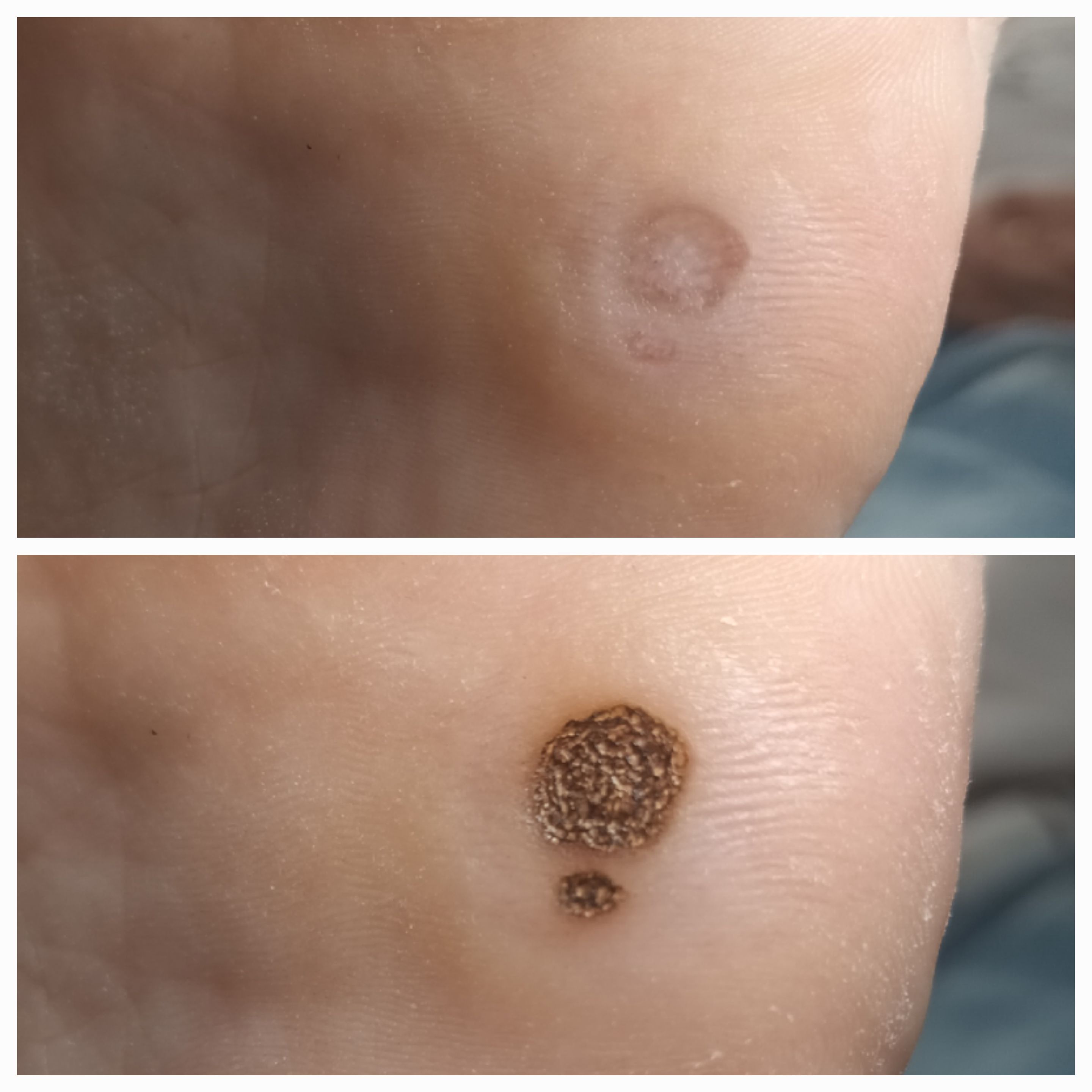 Usuwanie brodawek - zdjęcie 2