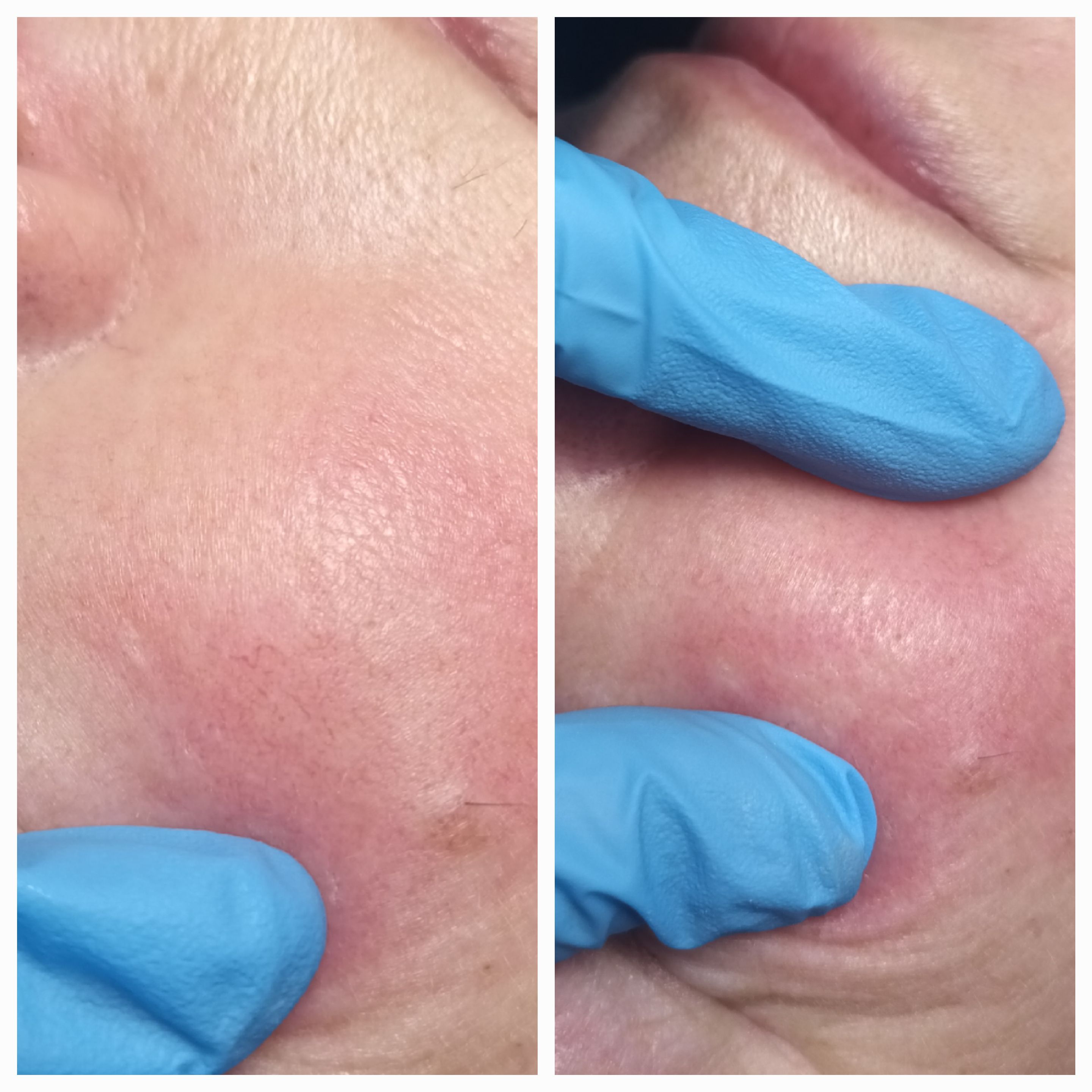 Zamykanie naczynek i usuwanie włókniaków - zdjęcie 2