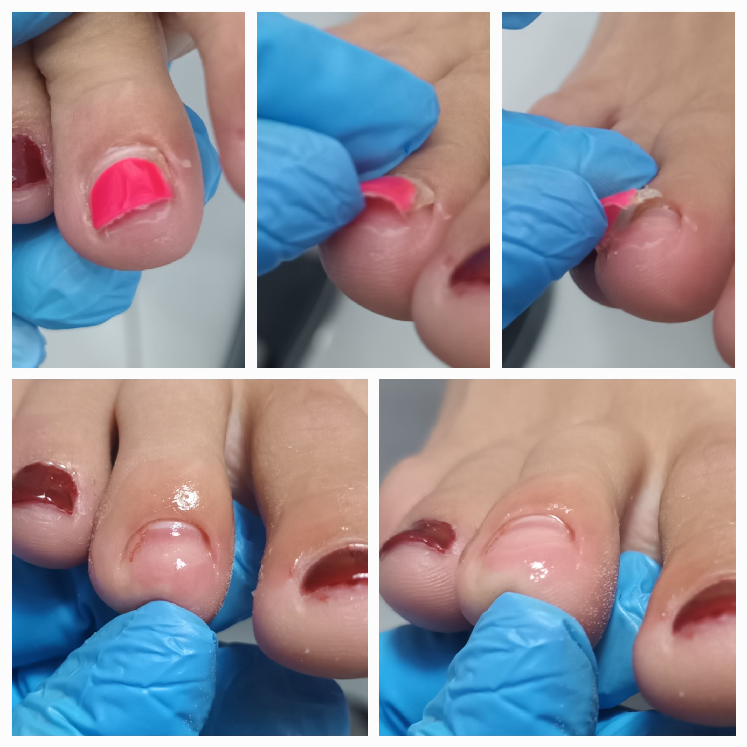 Choroby i defekty płytki paznokciowej - zdjęcie 3