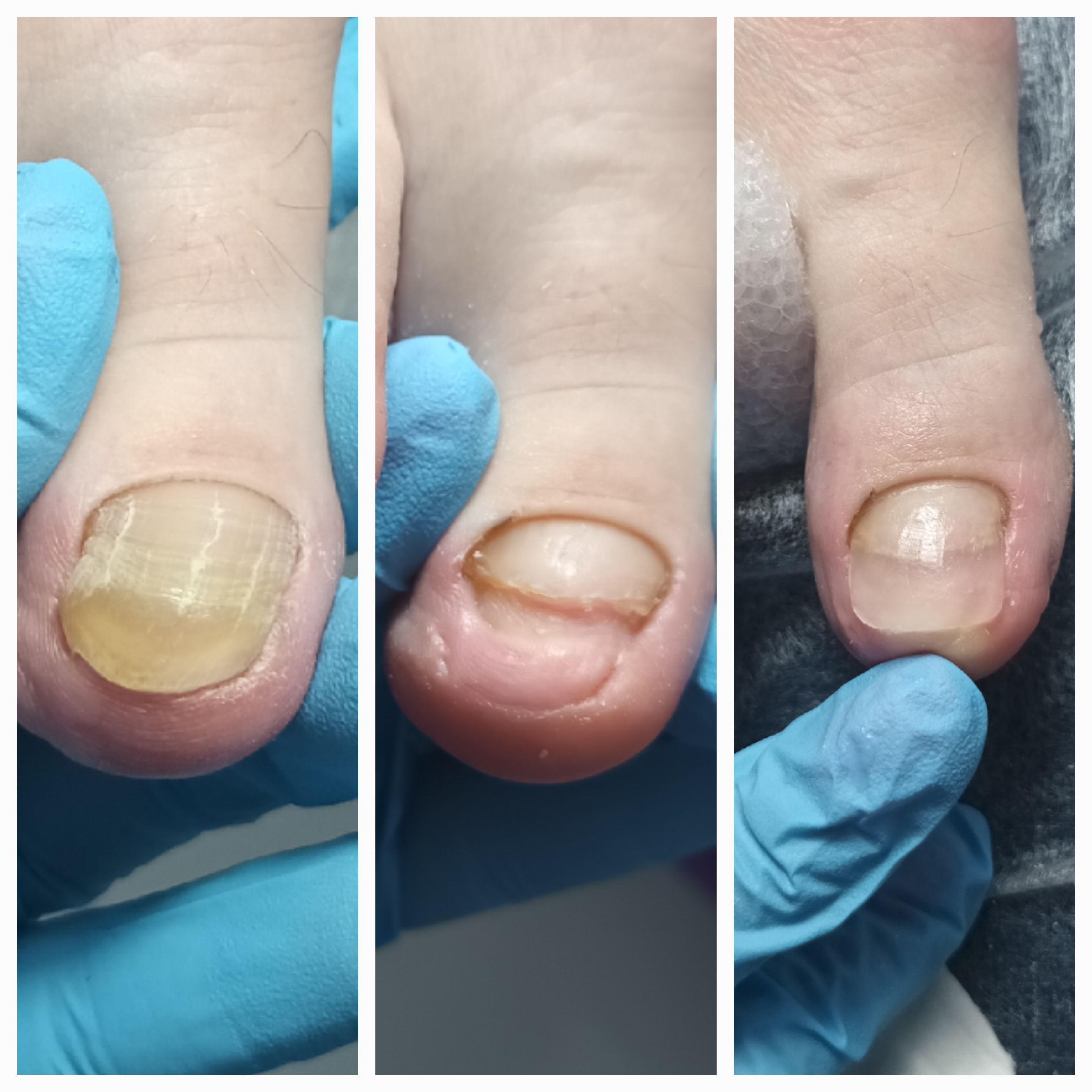 Klamry i rekonstrukcje podologiczne - zdjęcie 3