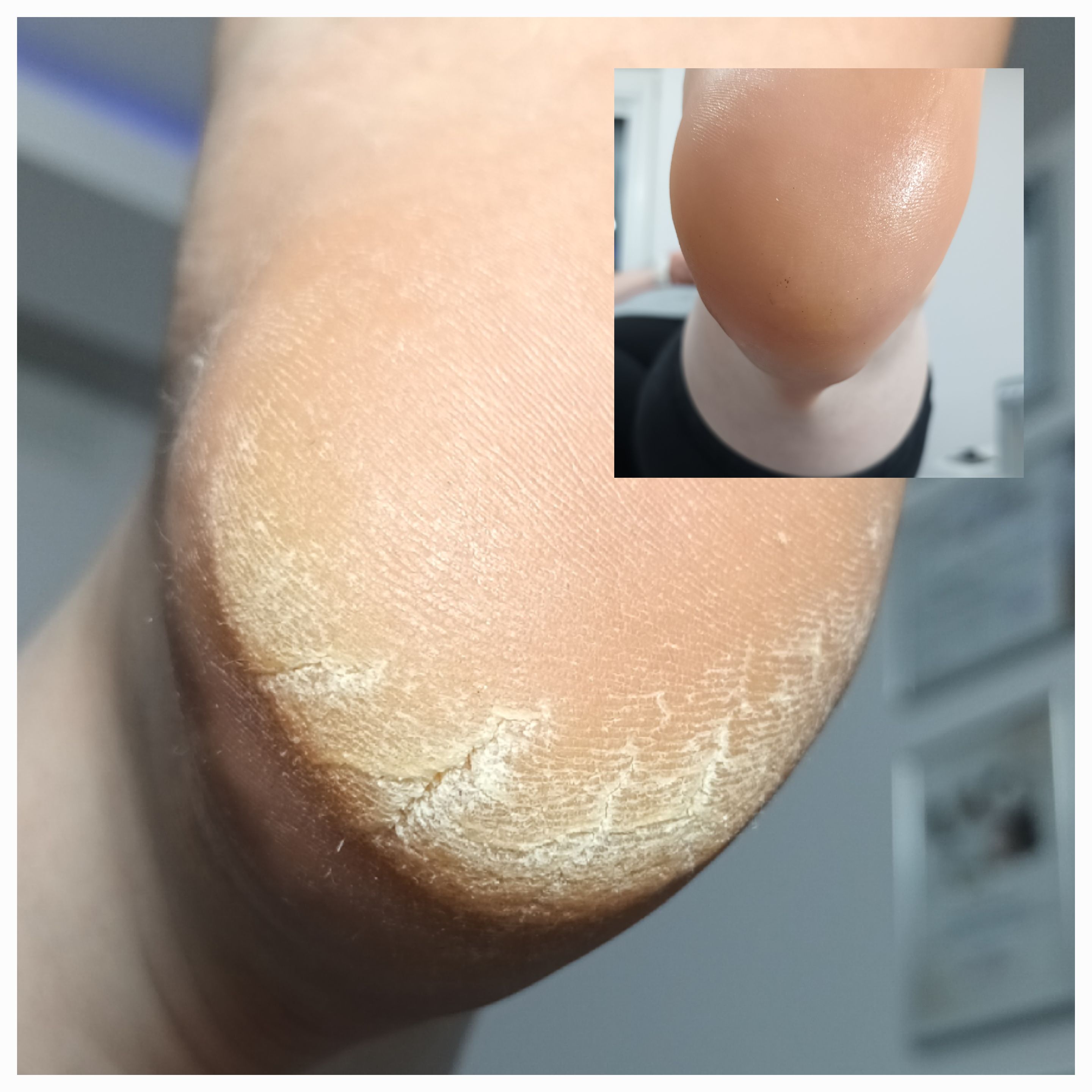 Pedicure leczniczy - zdjęcie 3