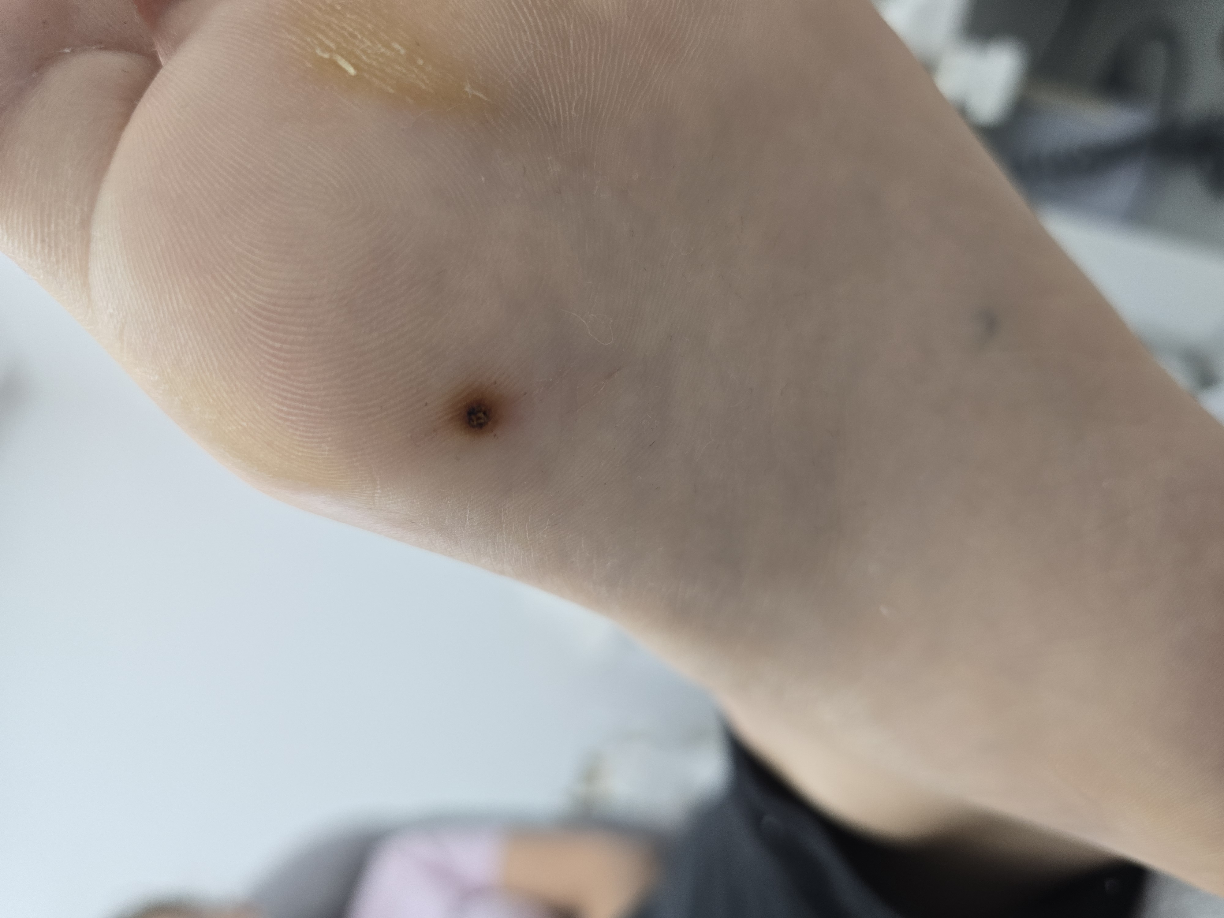 Usuwanie brodawek - zdjęcie 3