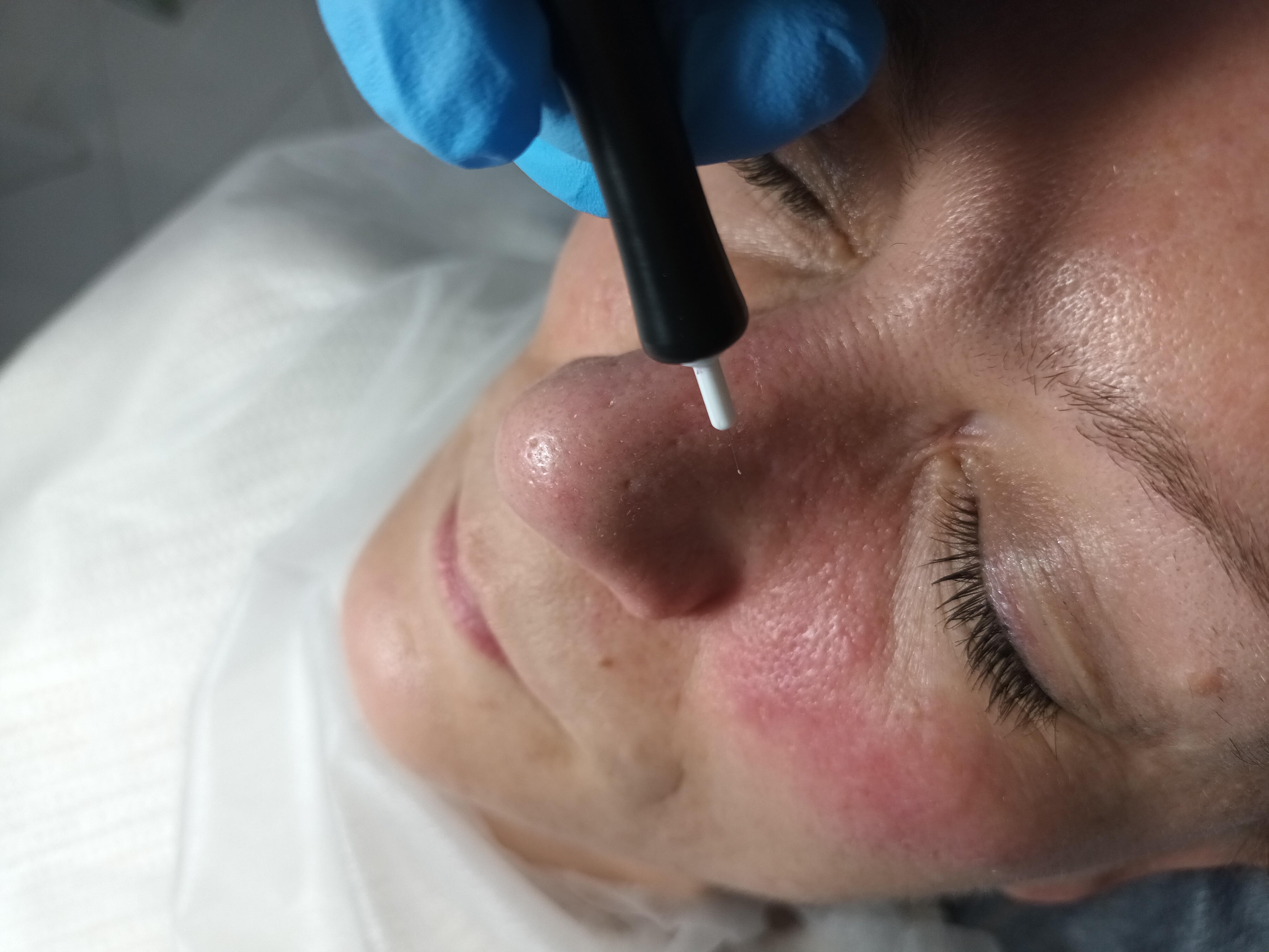 Zamykanie naczynek i usuwanie włókniaków - zdjęcie 3