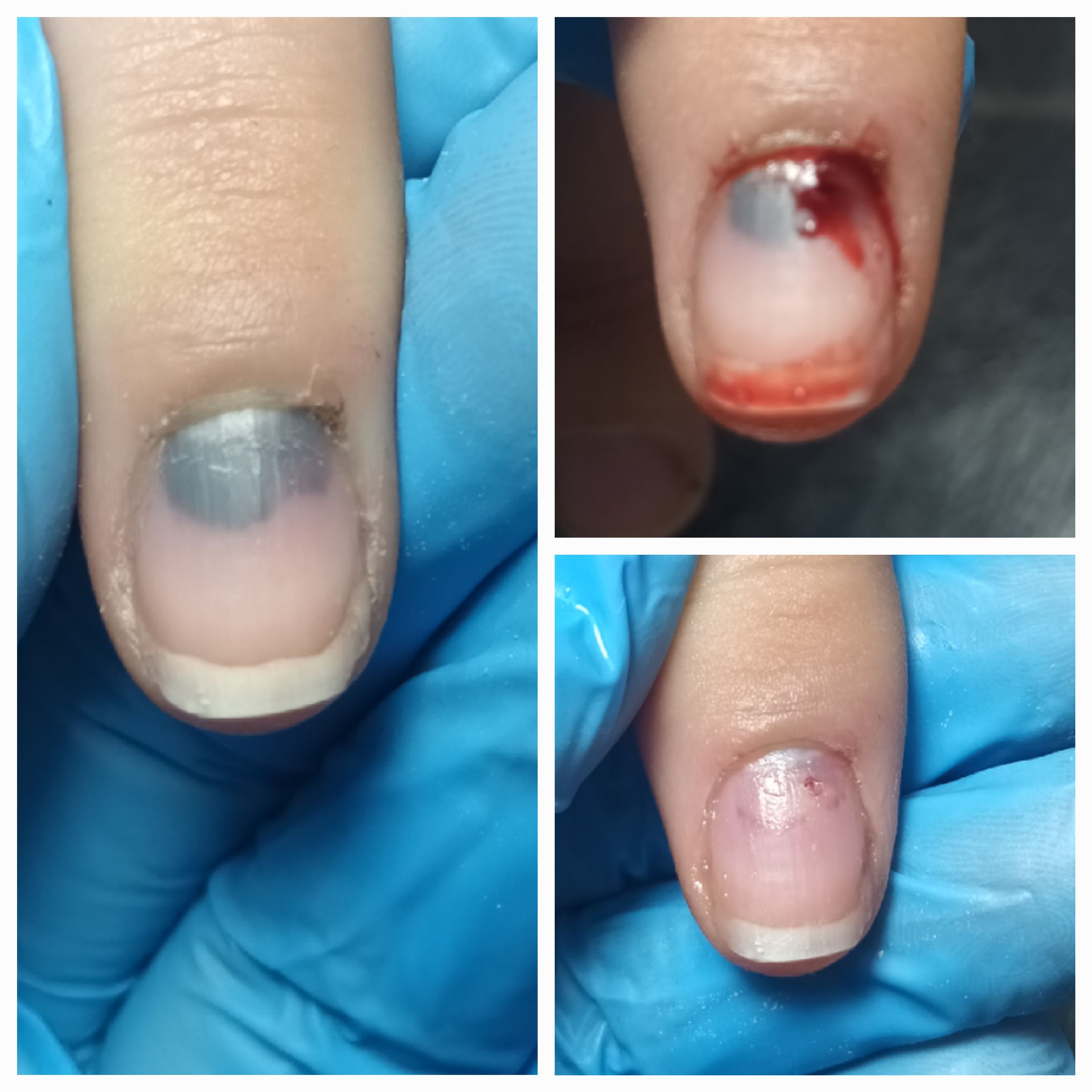 Choroby i defekty płytki paznokciowej - zdjęcie 4