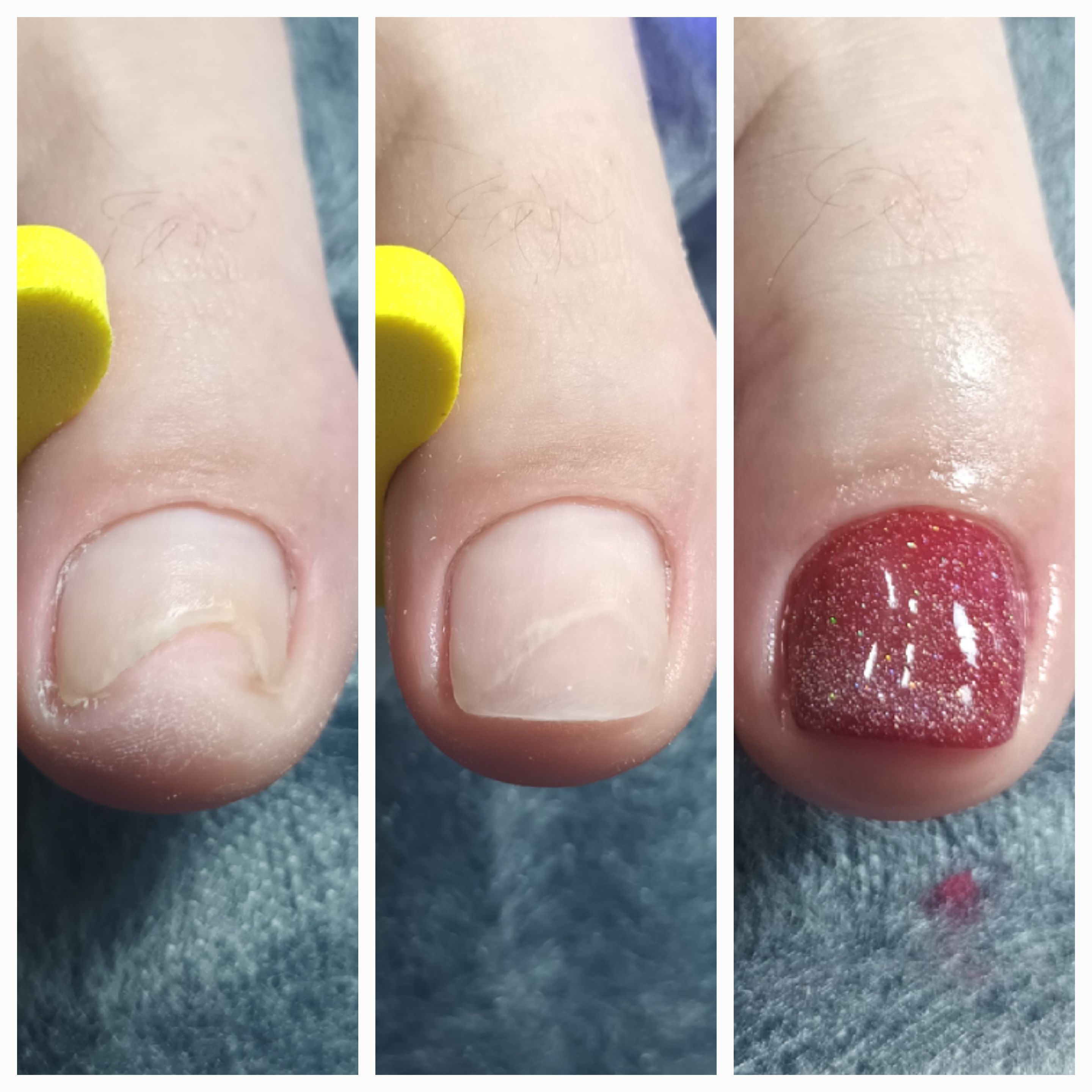 Klamry i rekonstrukcje podologiczne - zdjęcie 4