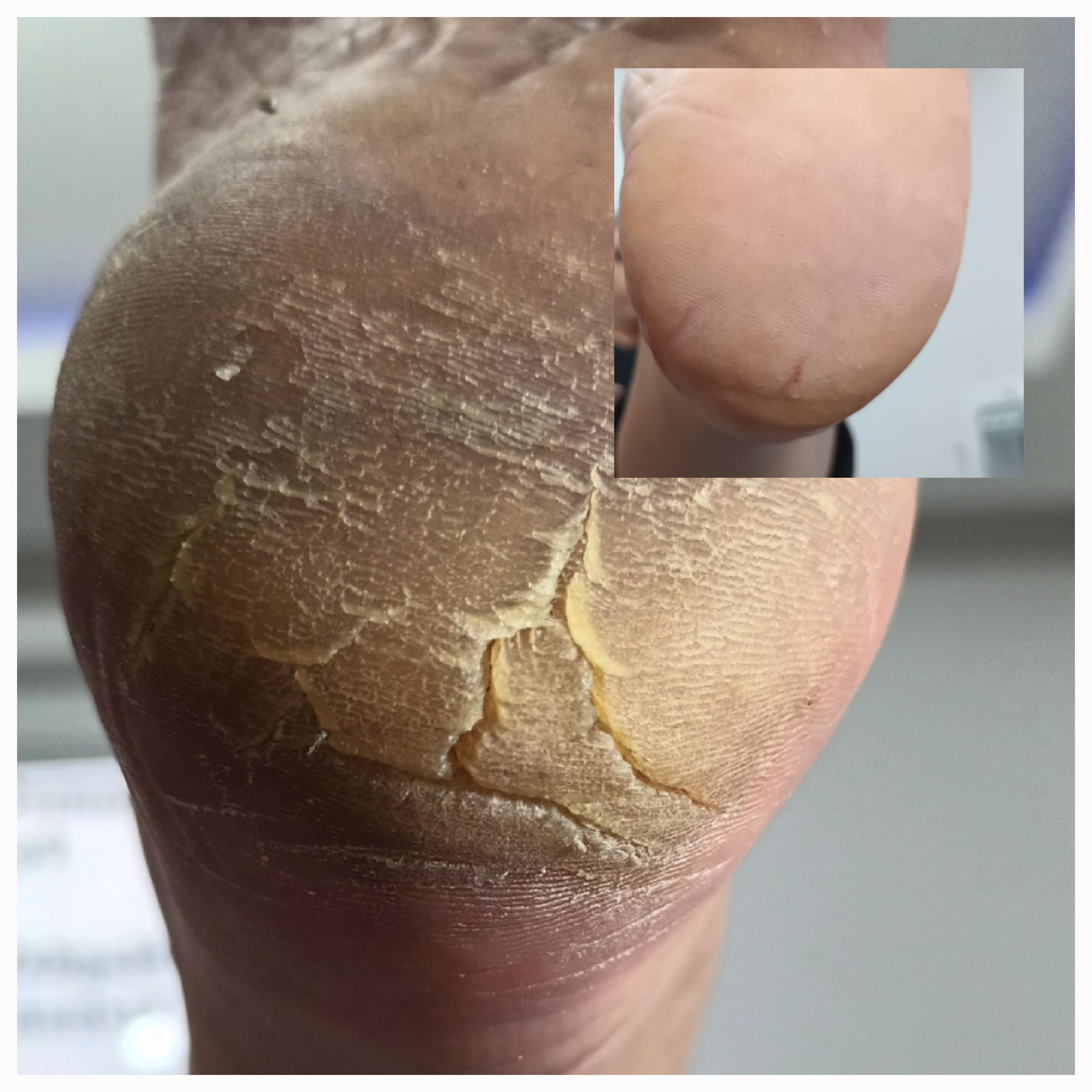 Pedicure leczniczy - zdjęcie 4