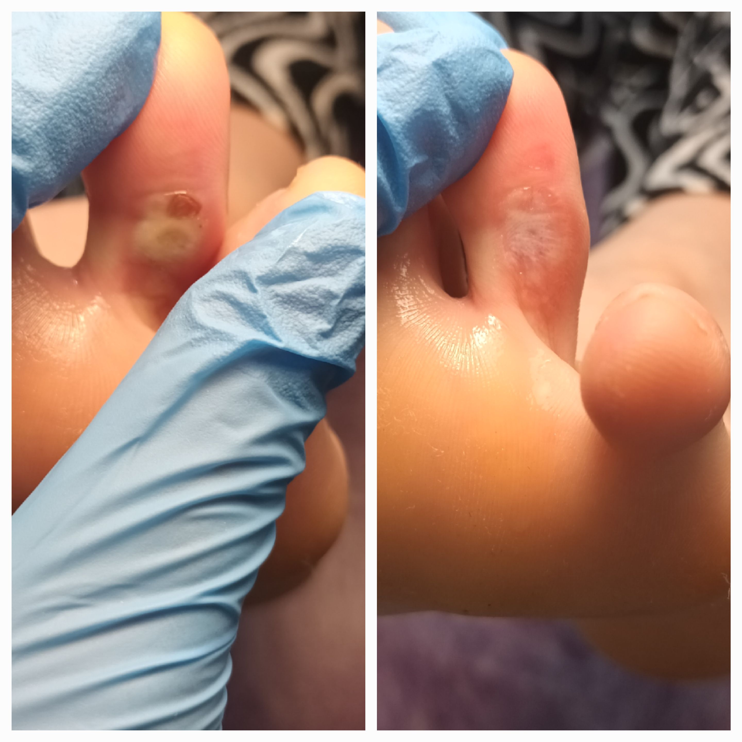 Usuwanie modzeli i odcisków - zdjęcie 4