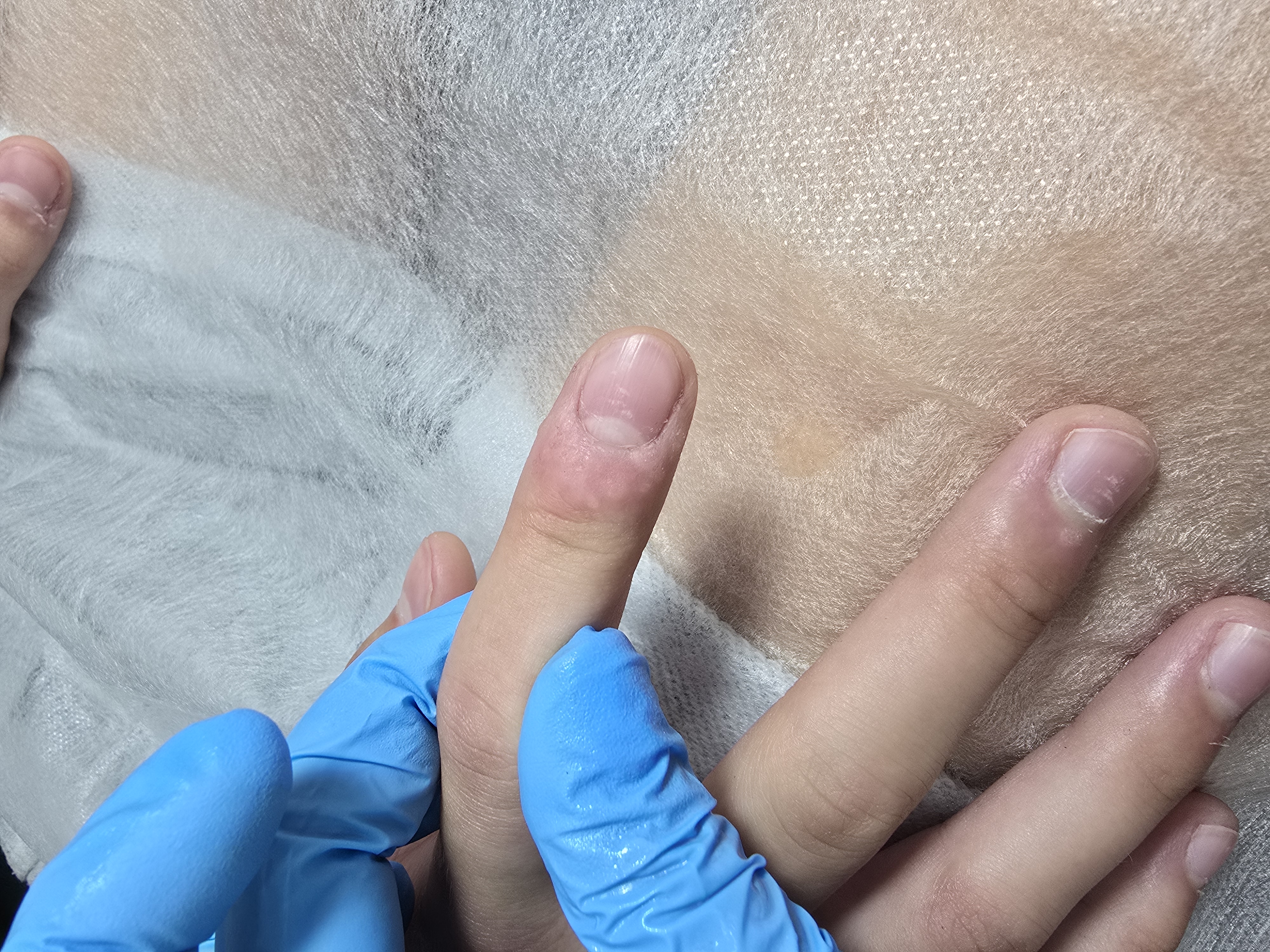 Usuwanie brodawek - zdjęcie 4