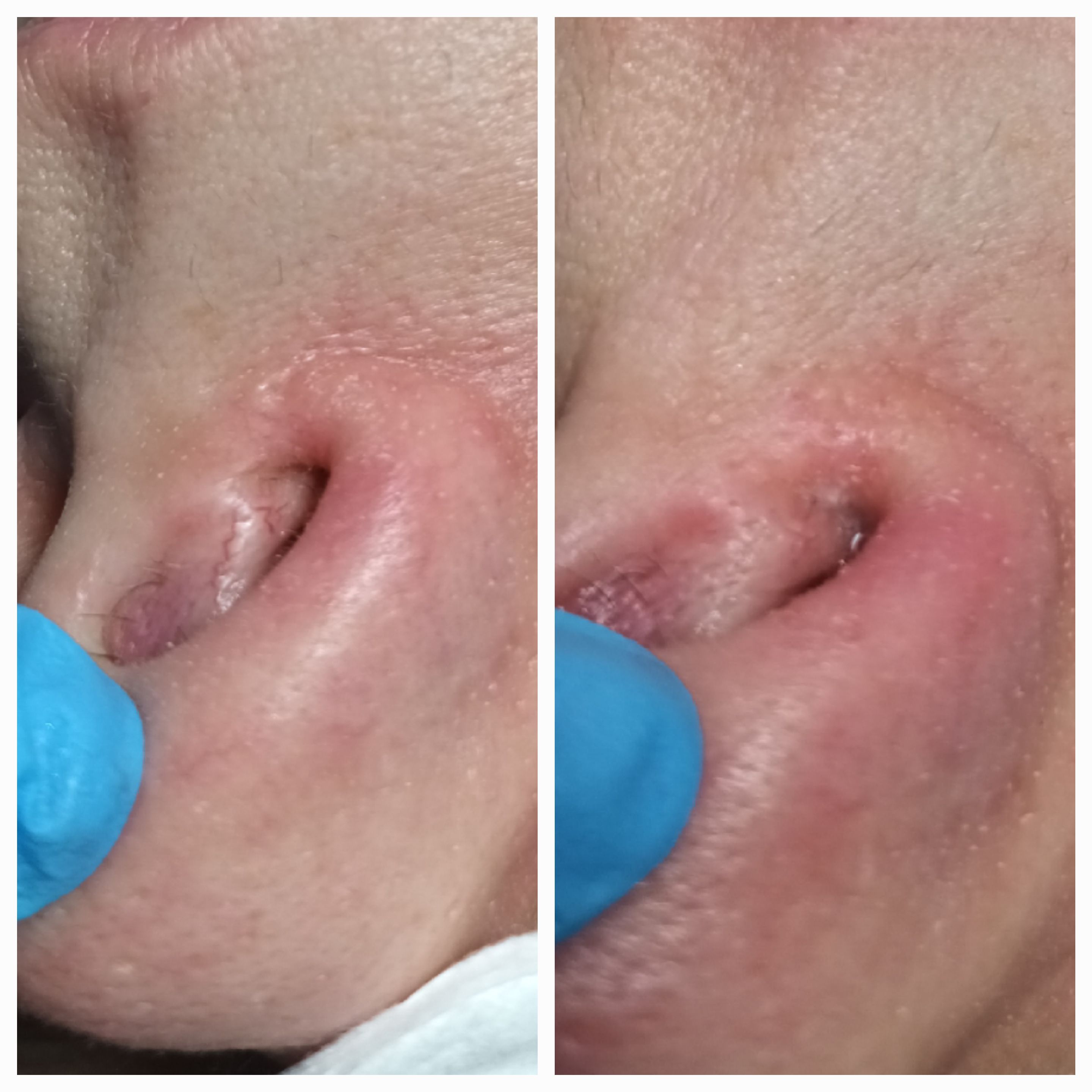 Zamykanie naczynek i usuwanie włókniaków - zdjęcie 4