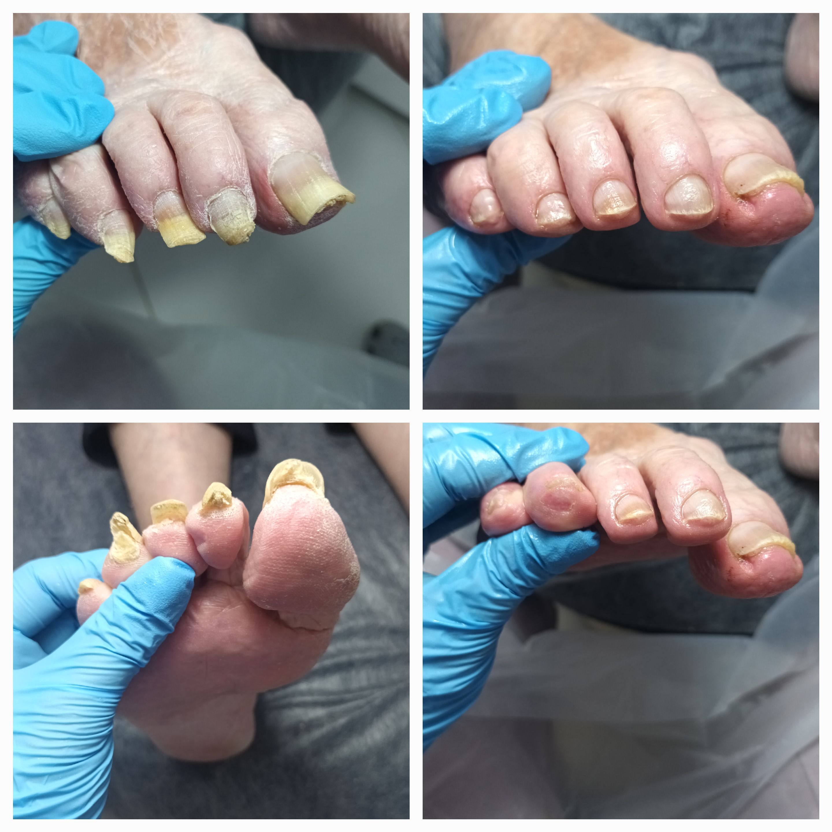 Choroby i defekty płytki paznokciowej - zdjęcie 5