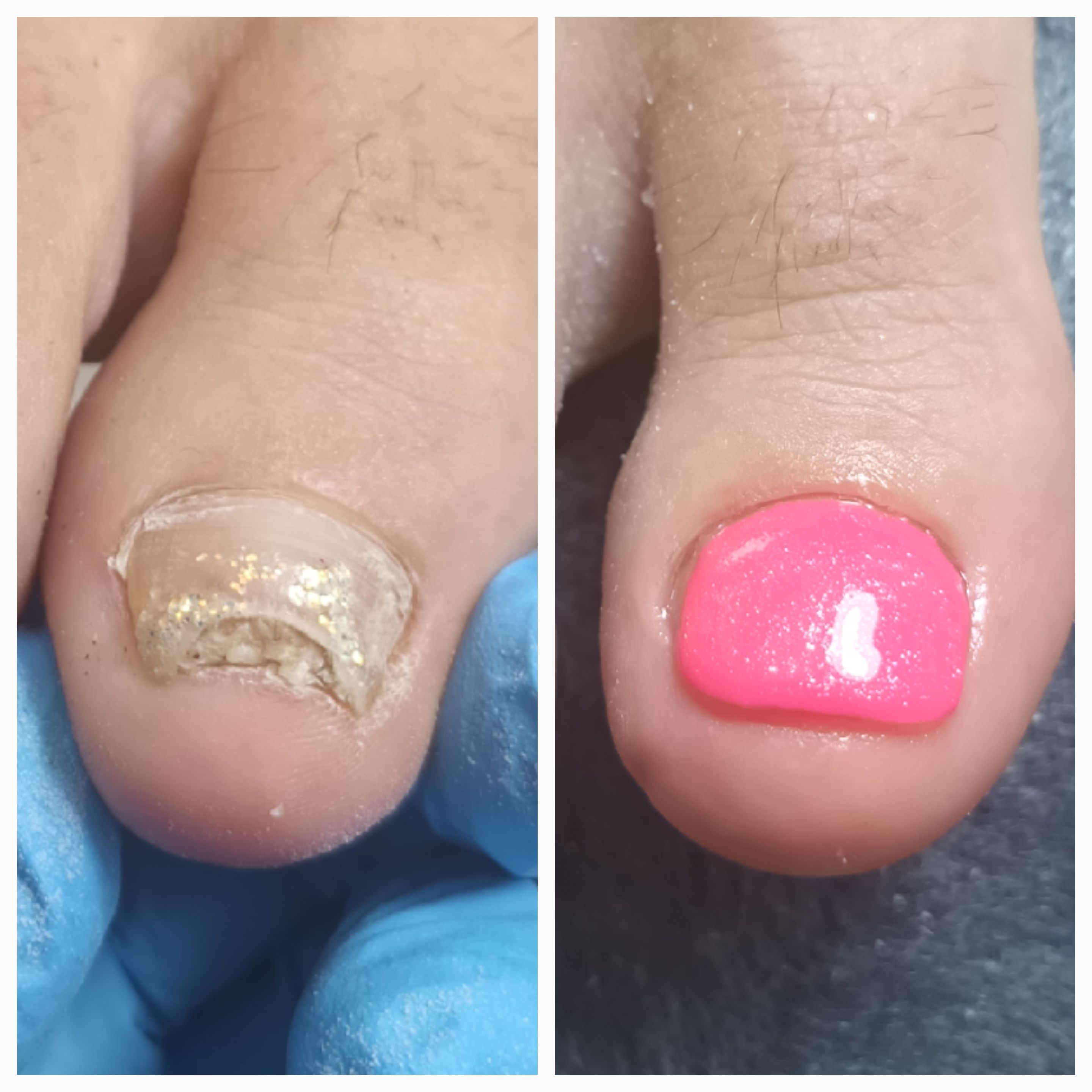 Klamry i rekonstrukcje podologiczne - zdjęcie 5