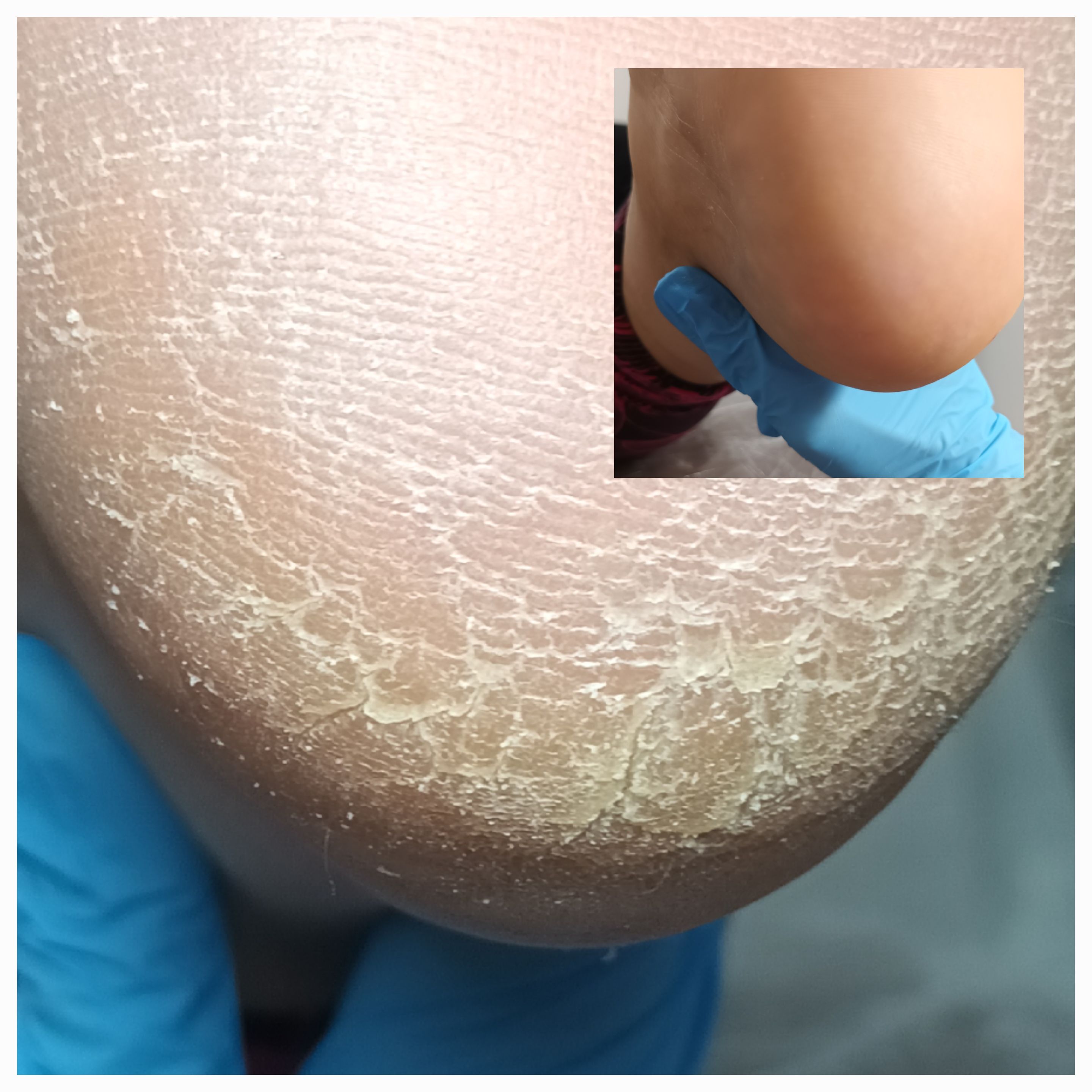 Pedicure leczniczy - zdjęcie 5