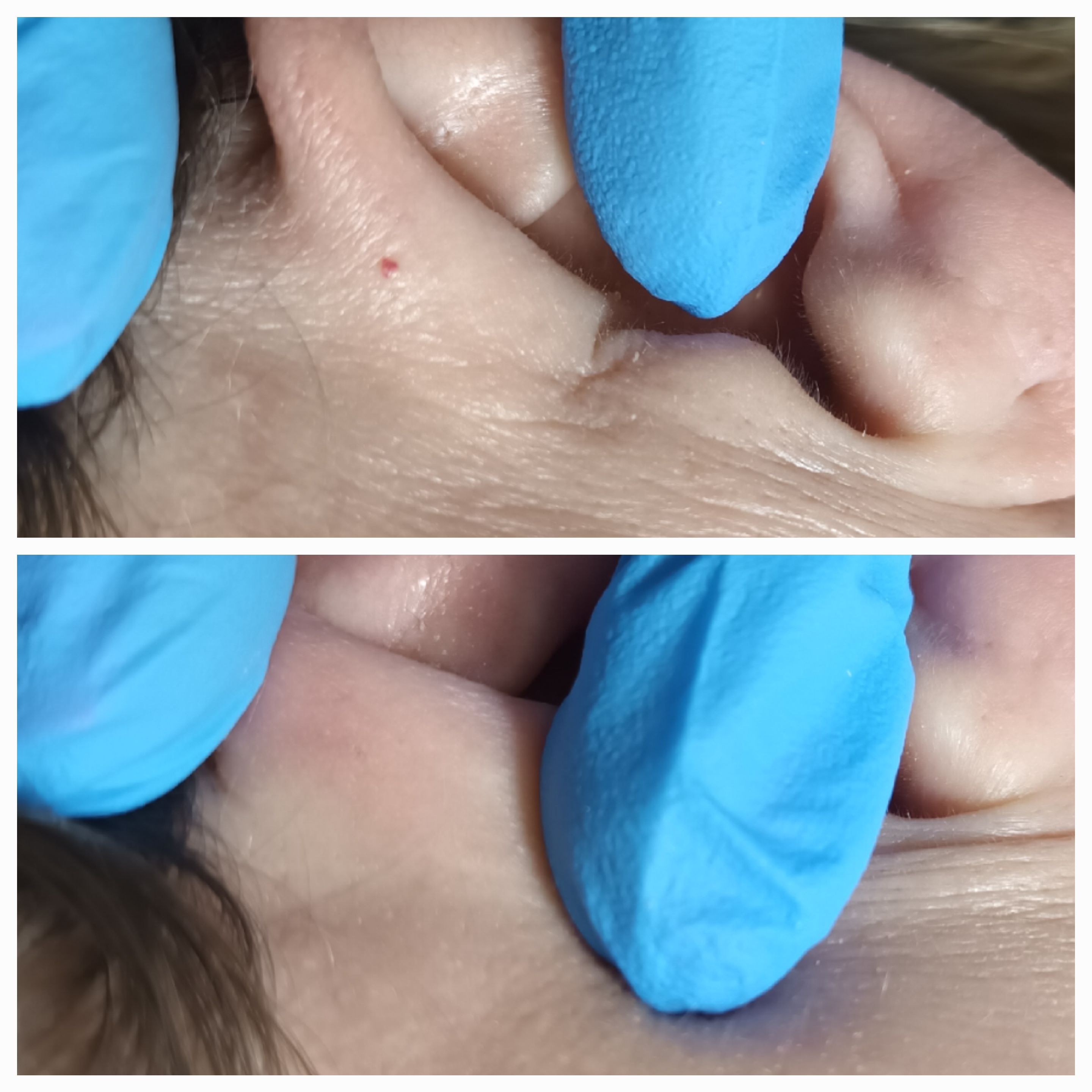 Zamykanie naczynek i usuwanie włókniaków - zdjęcie 5