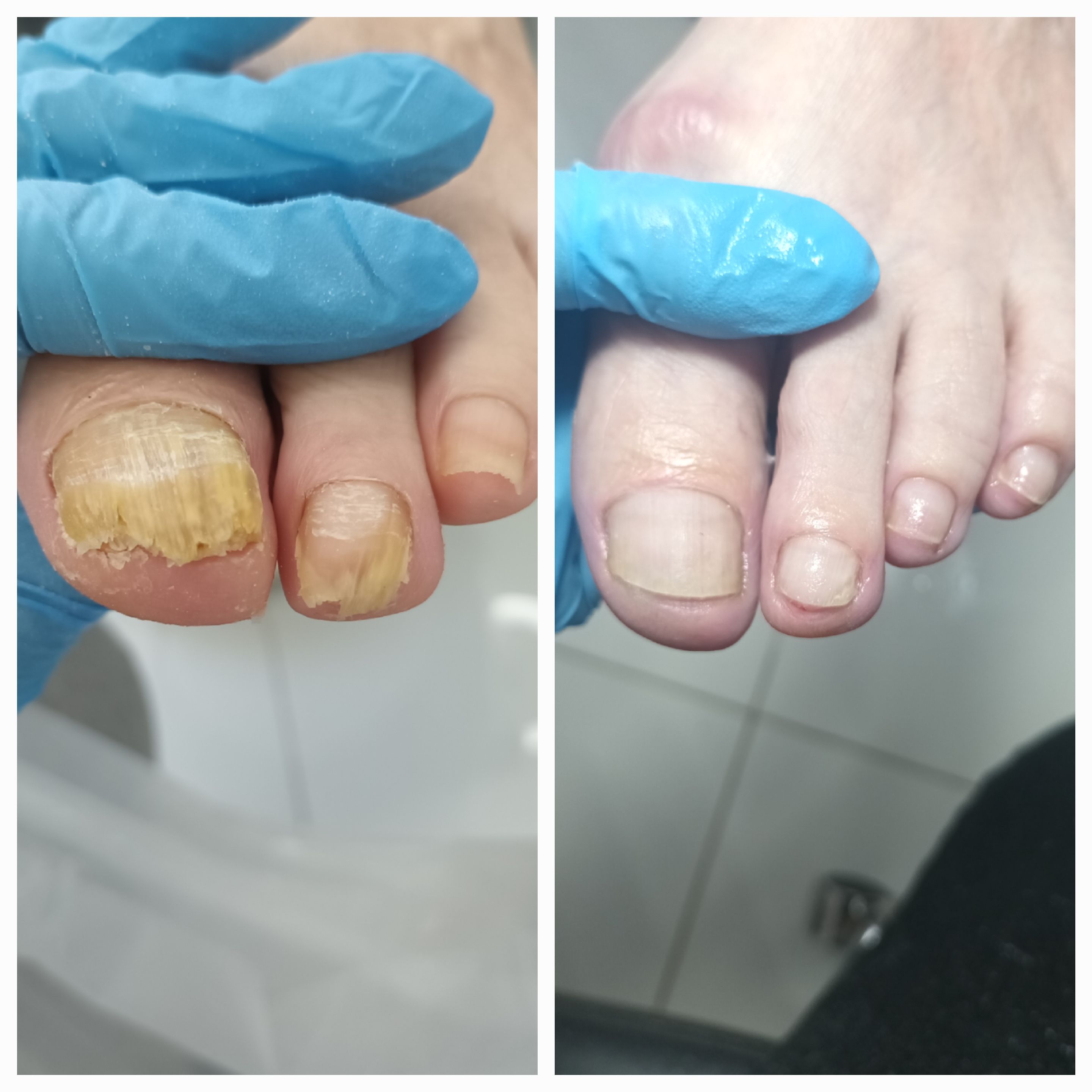 Choroby i defekty płytki paznokciowej - zdjęcie 6