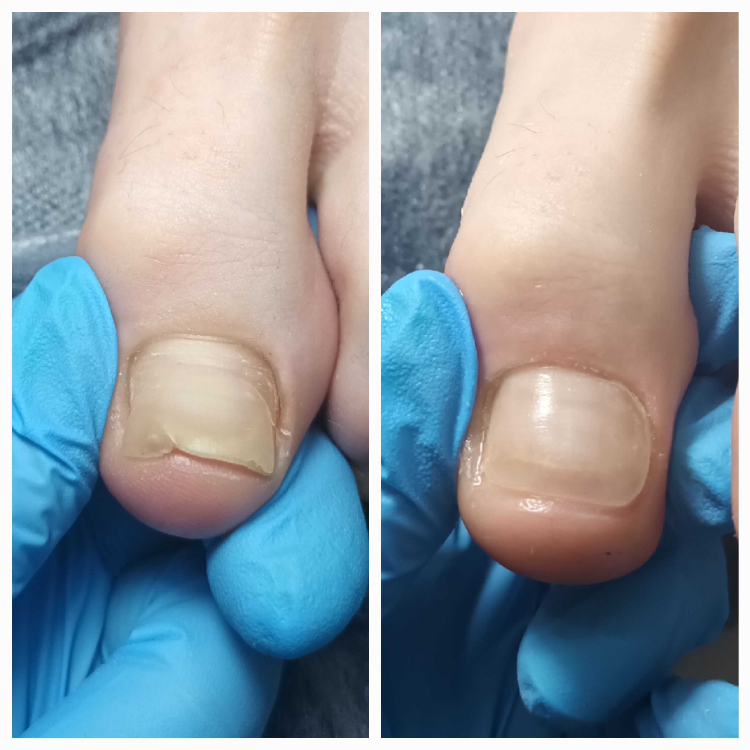 Klamry i rekonstrukcje podologiczne - zdjęcie 6